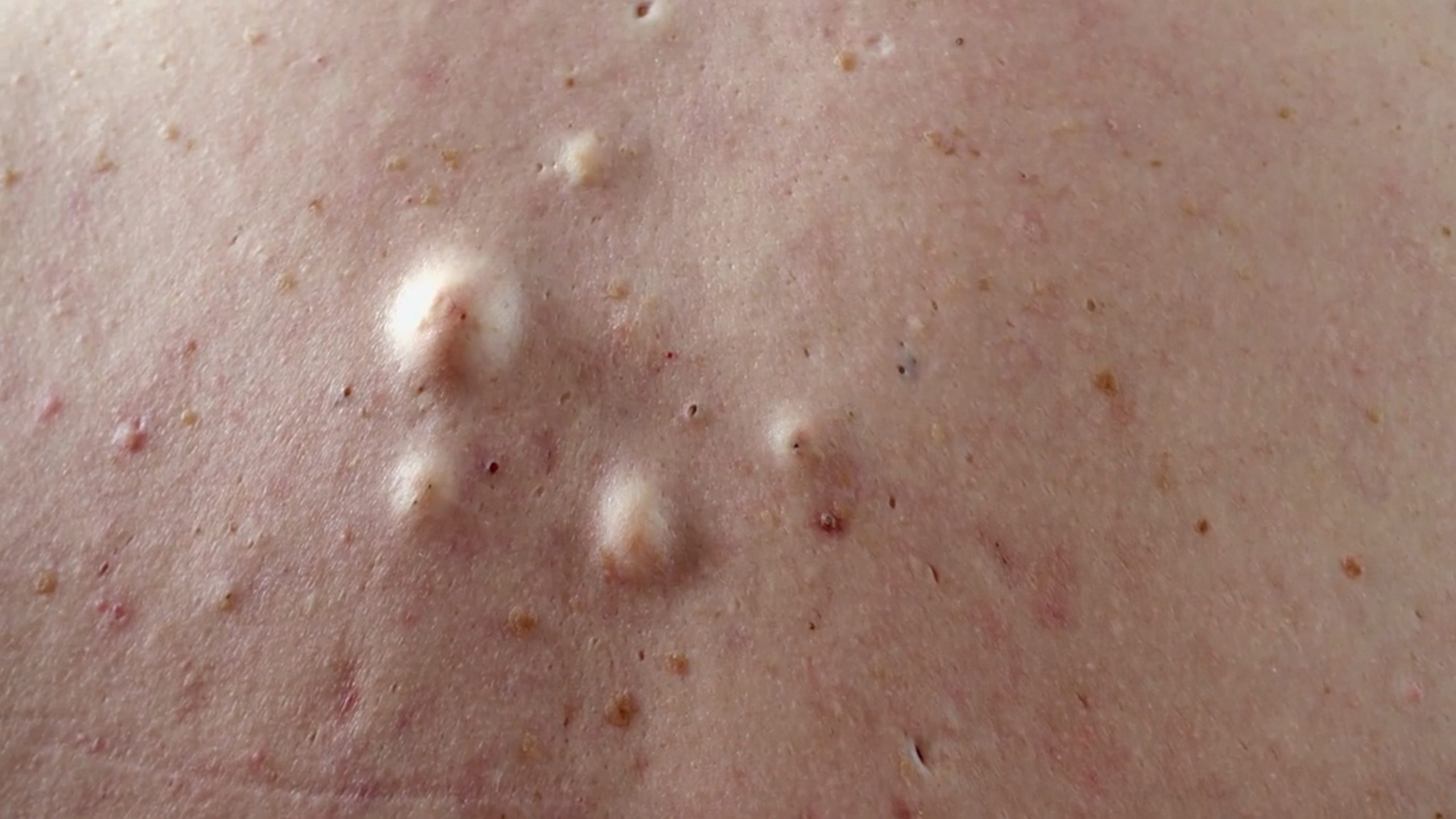 Scott’s odorous cysts are ruining his life. SaveMySkin 210626
