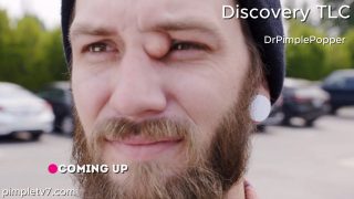 Shane has a growth between his eyes that could put him in danger at his electrician job. Dr. Pimple Popper 140626