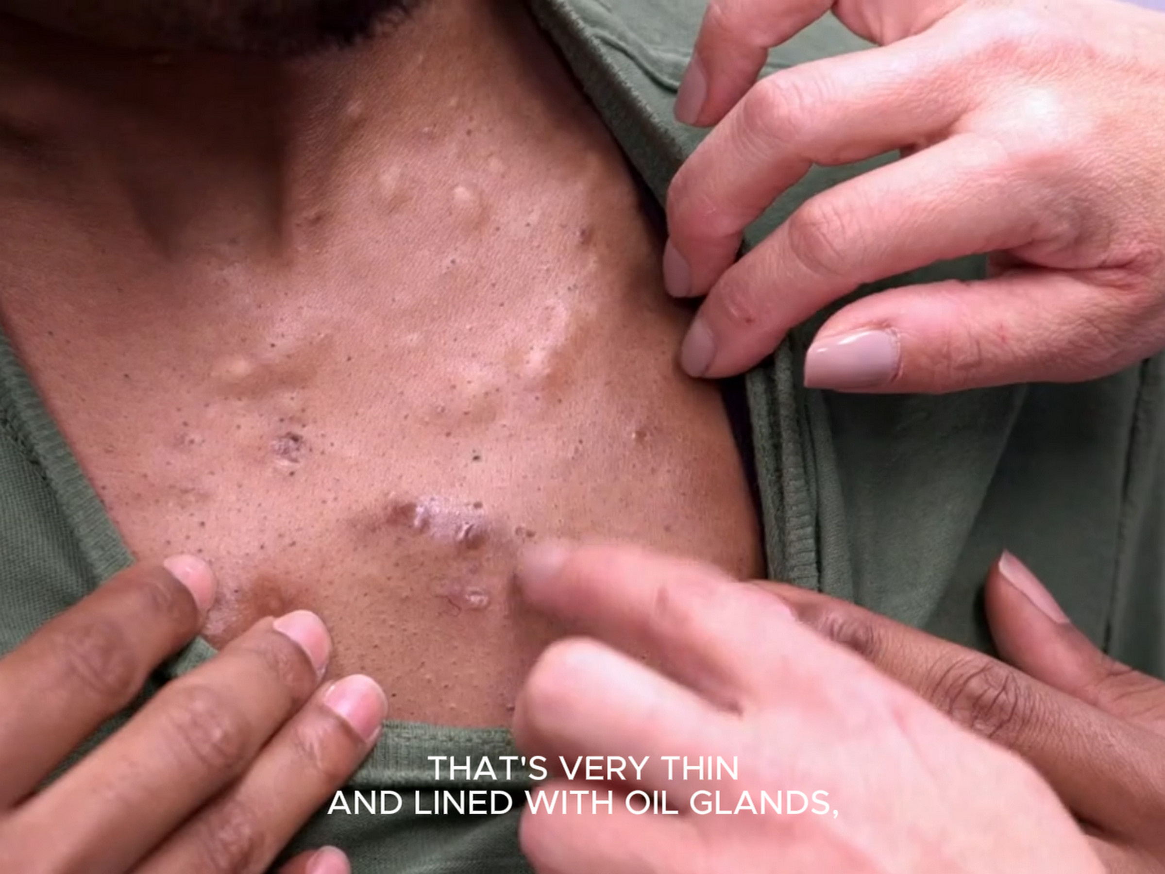 Tahj has basically a bunch of little puffy bumps that turn into big painful boils. Dr. Pimple Popper 170626