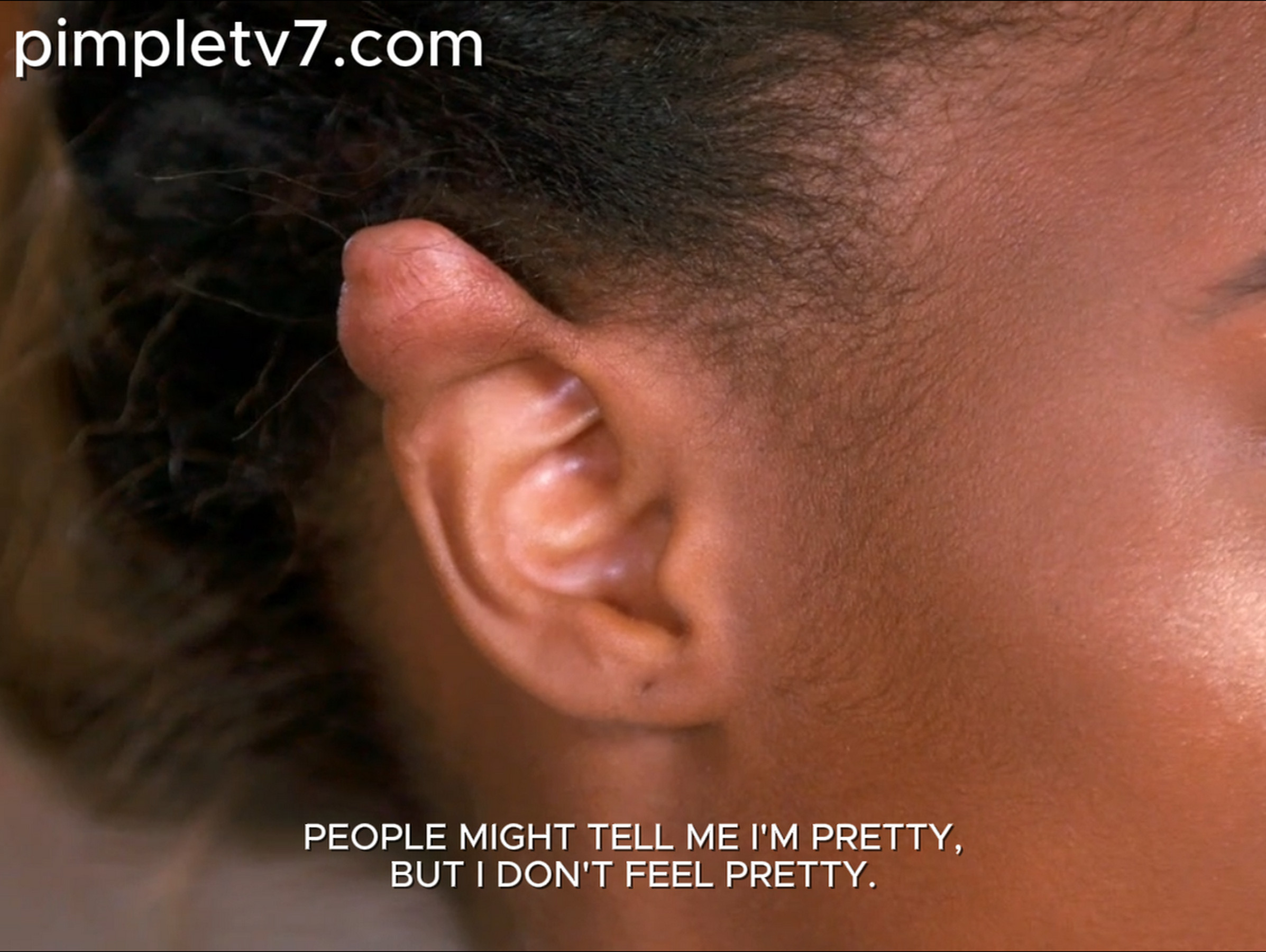 Taylore is a beautiful young woman with unsightly elf-like bumps on her ears. Dr. Pimple Popper 260626