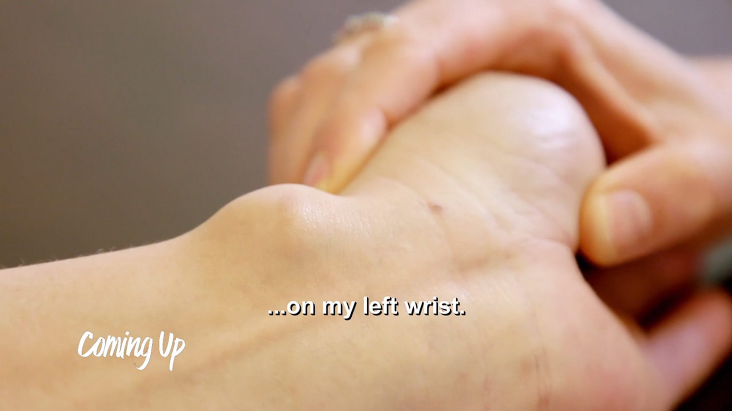 The ganglion cyst on Janette’s wrist is the biggest Dr. Emma has ever seen! SaveMySkin 270626