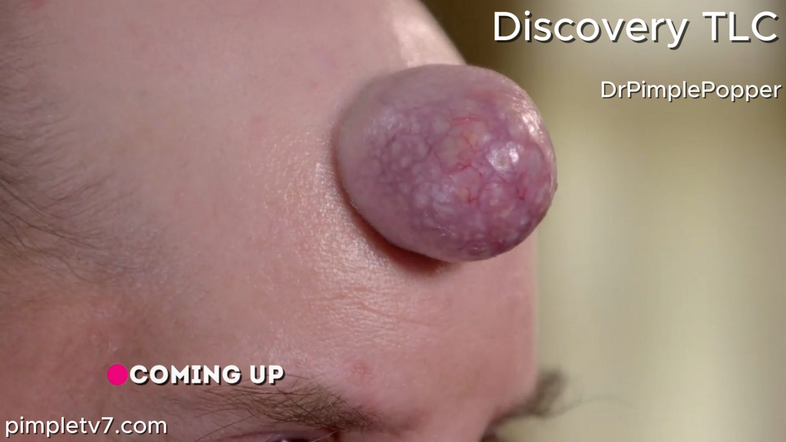 Todd has a bump protruding from his forehead that is painful and humiliating. Dr. Pimple Popper 230626