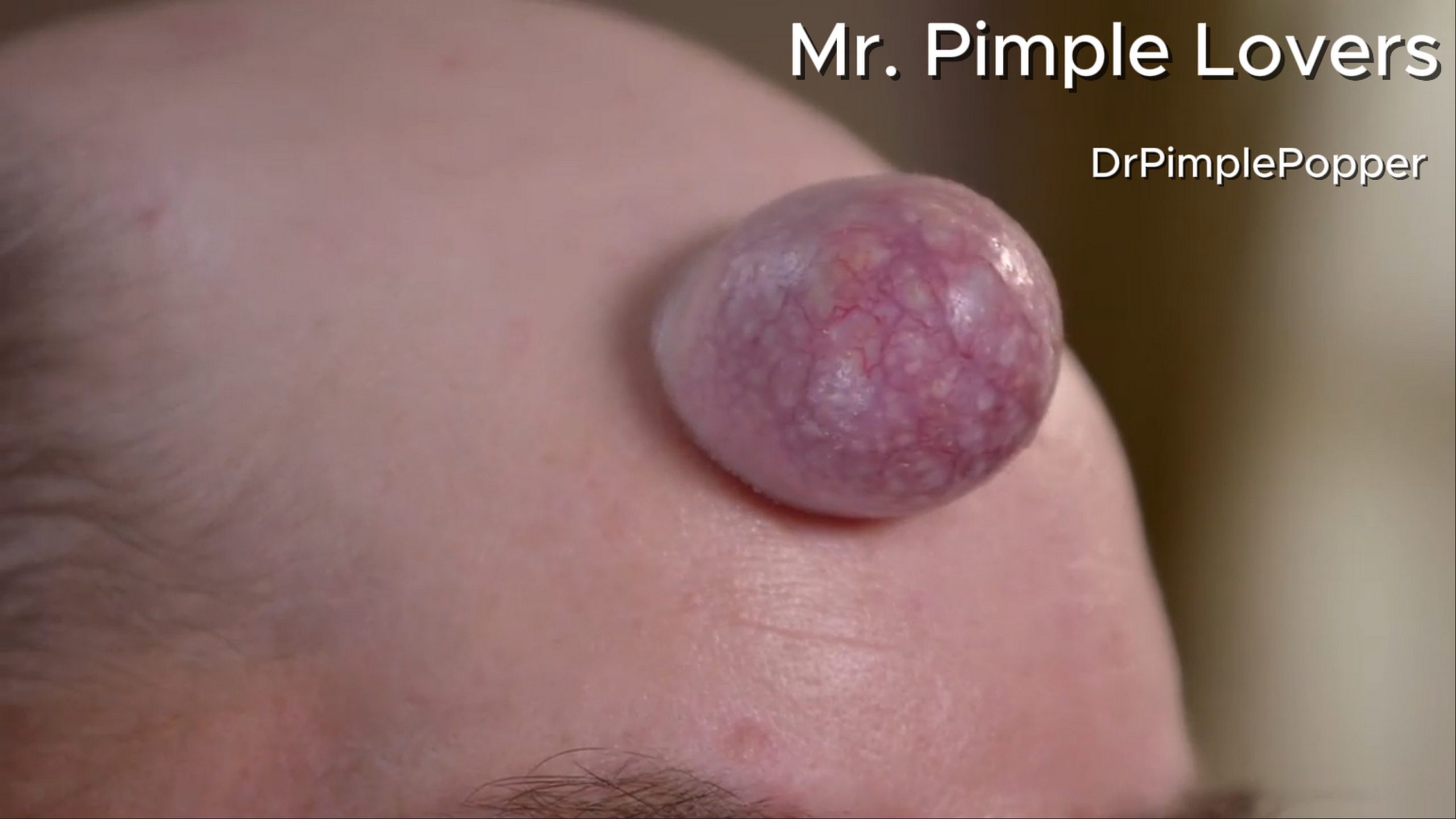 Todd has a bump protruding from his forehead that is painful and humiliating. Dr. Pimple Popper 140626