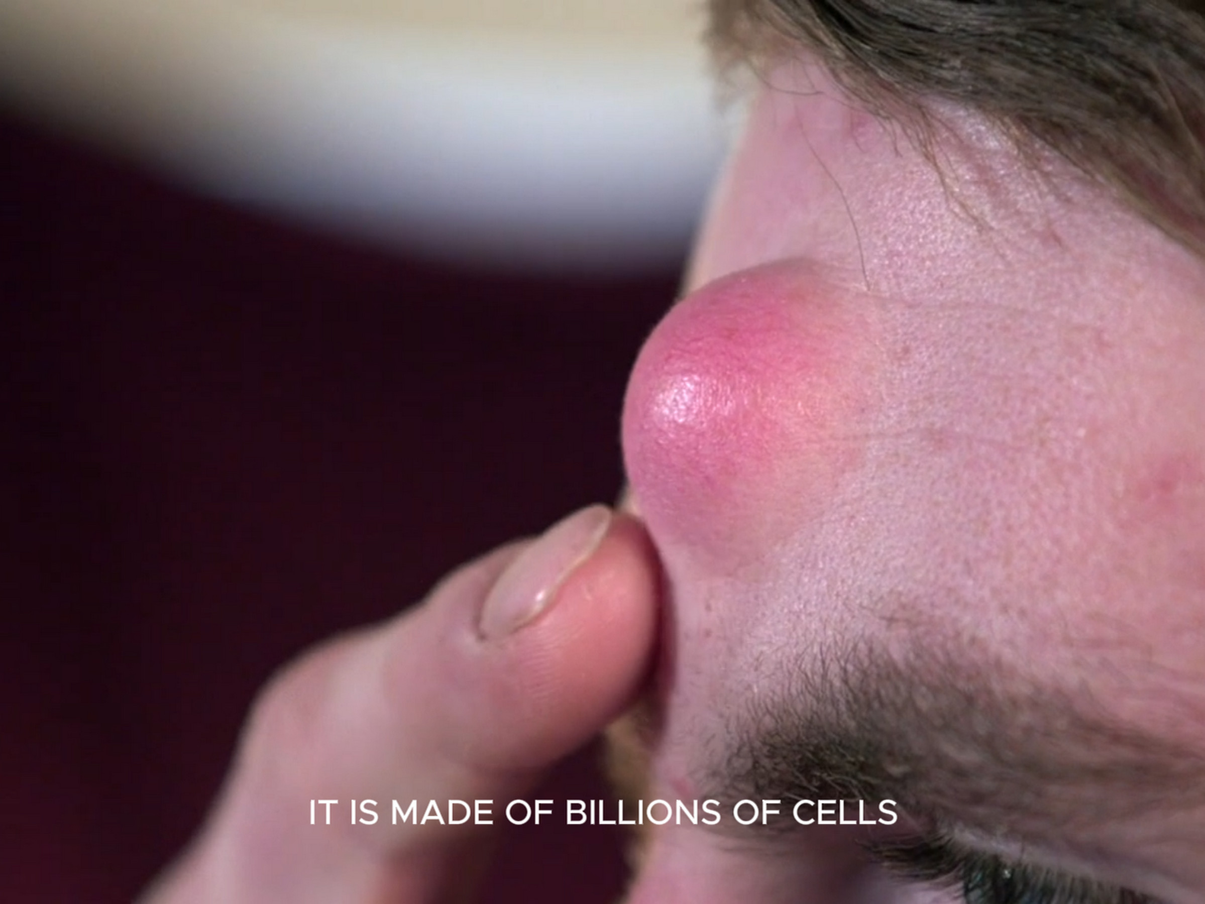 Dr. Sandra Lee: Tyler’s fear of cancer has kept him from having his head lumps diagnosed. Dr. Pimple Popper 140626