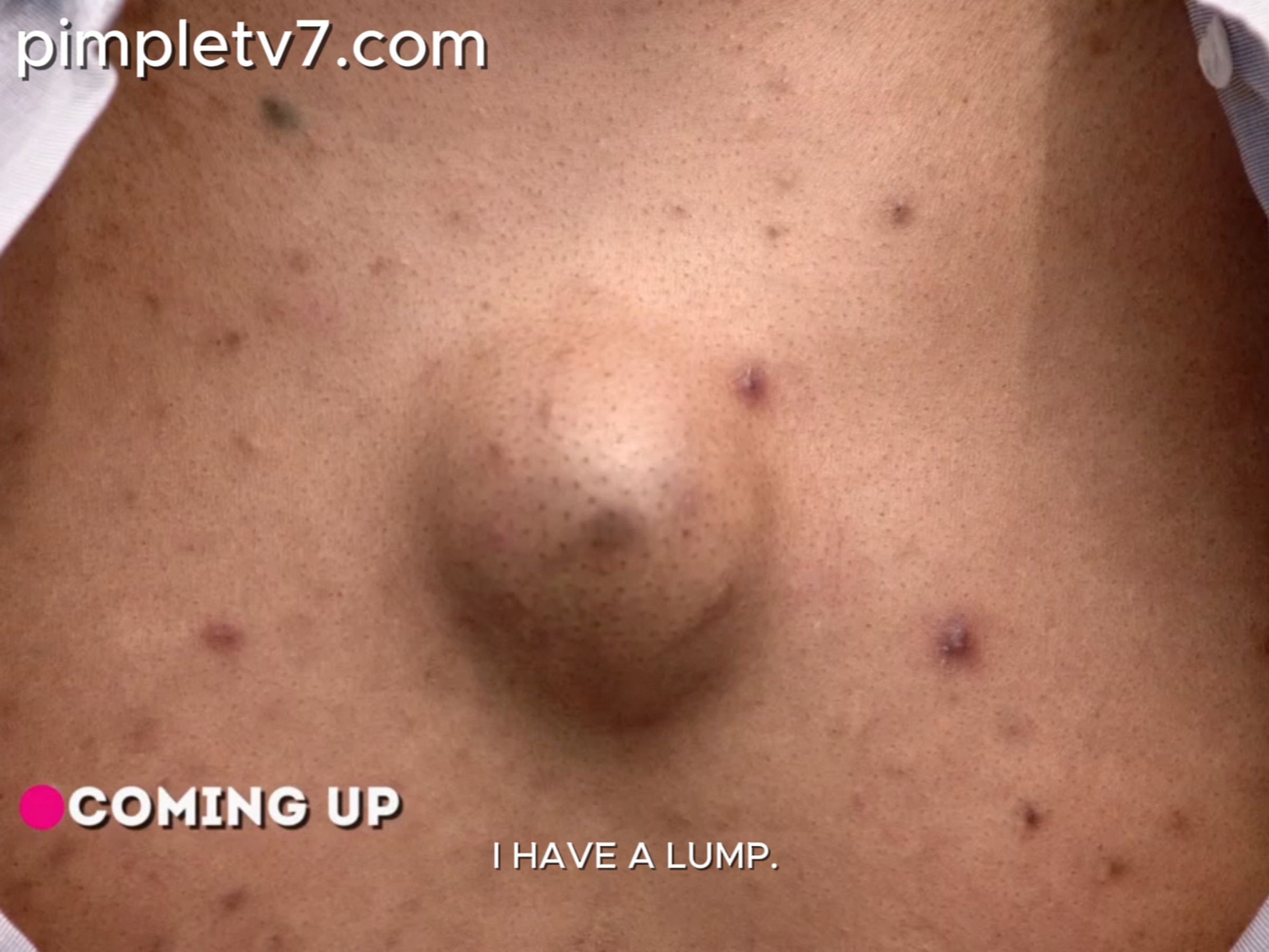 Victor has a lump in the middle of his chest. Dr. Pimple Popper 240626
