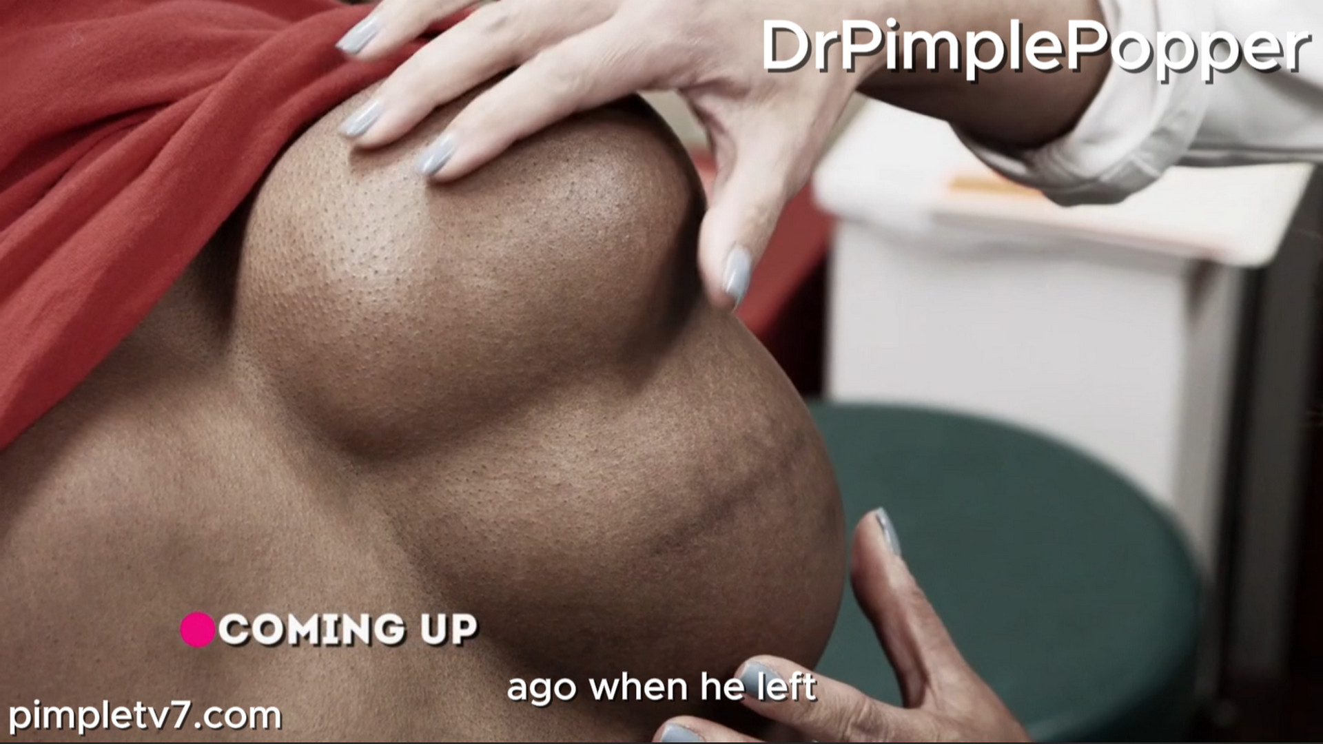 A former patient returns to find out if Dr. Sandra Lee has answers to help with with his recurring. Dr. Pimple Popper 190726