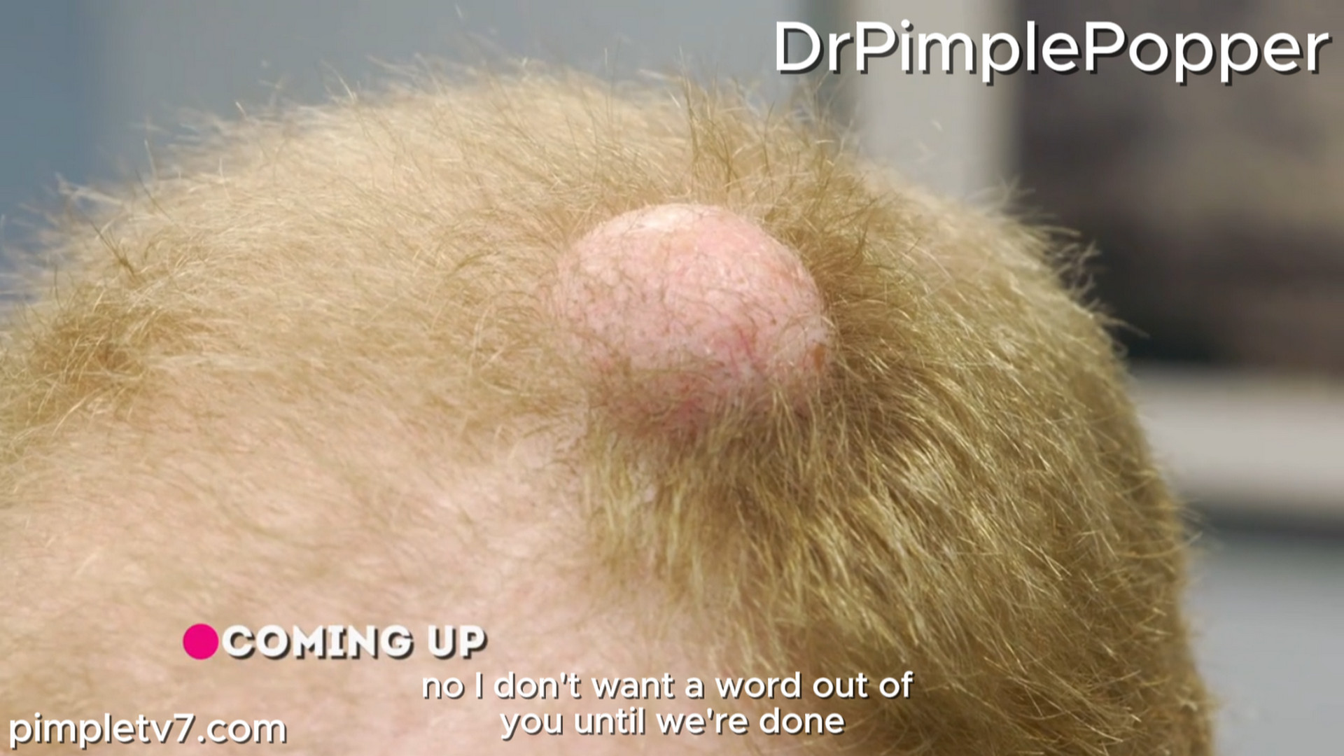 A man has a large bump on his head that he calls his “on-off button.” Dr. Pimple Popper 210726