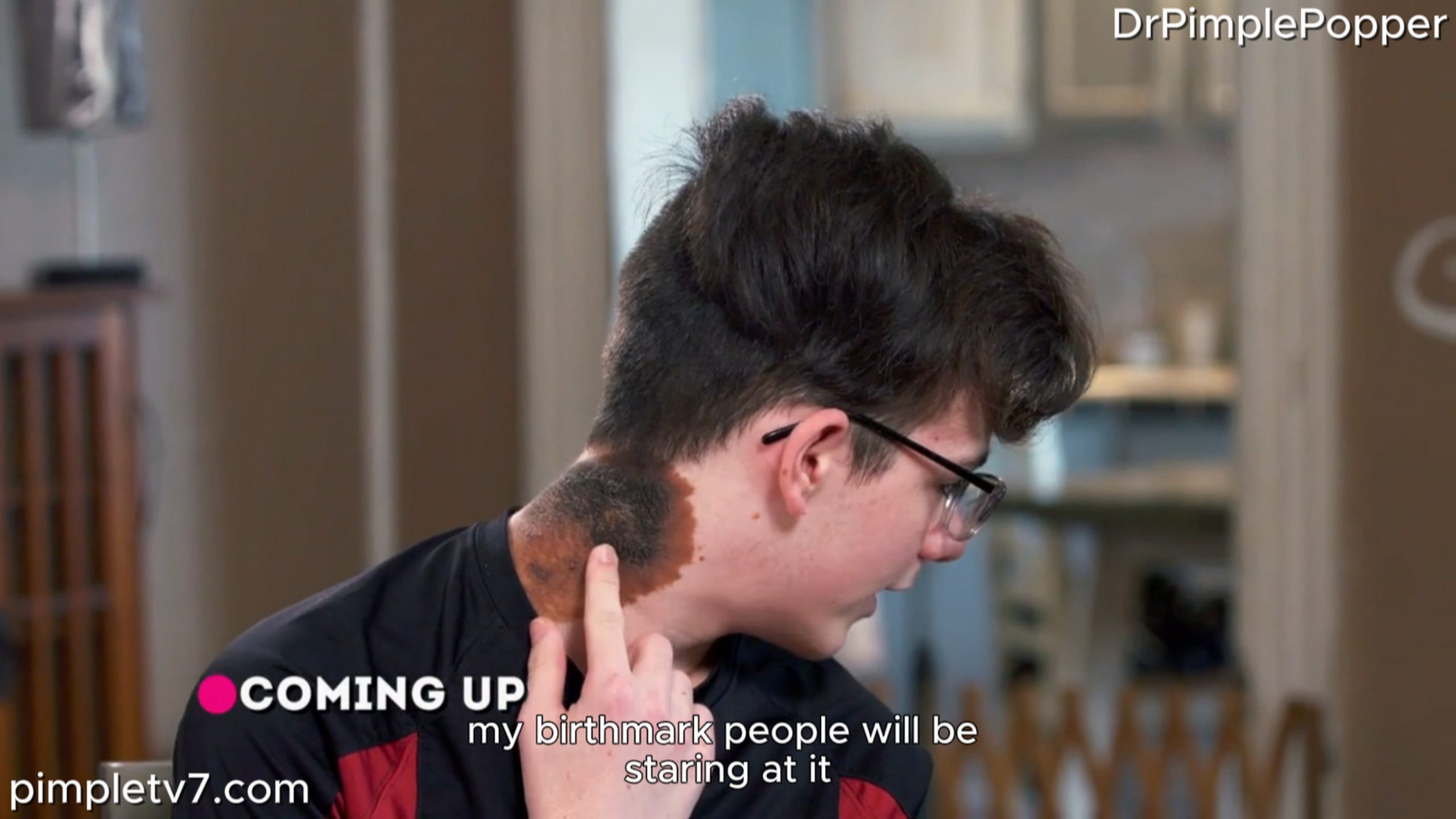 A man has a large, embarrassing birthmark on his neck. Dr. Pimple Popper 070726