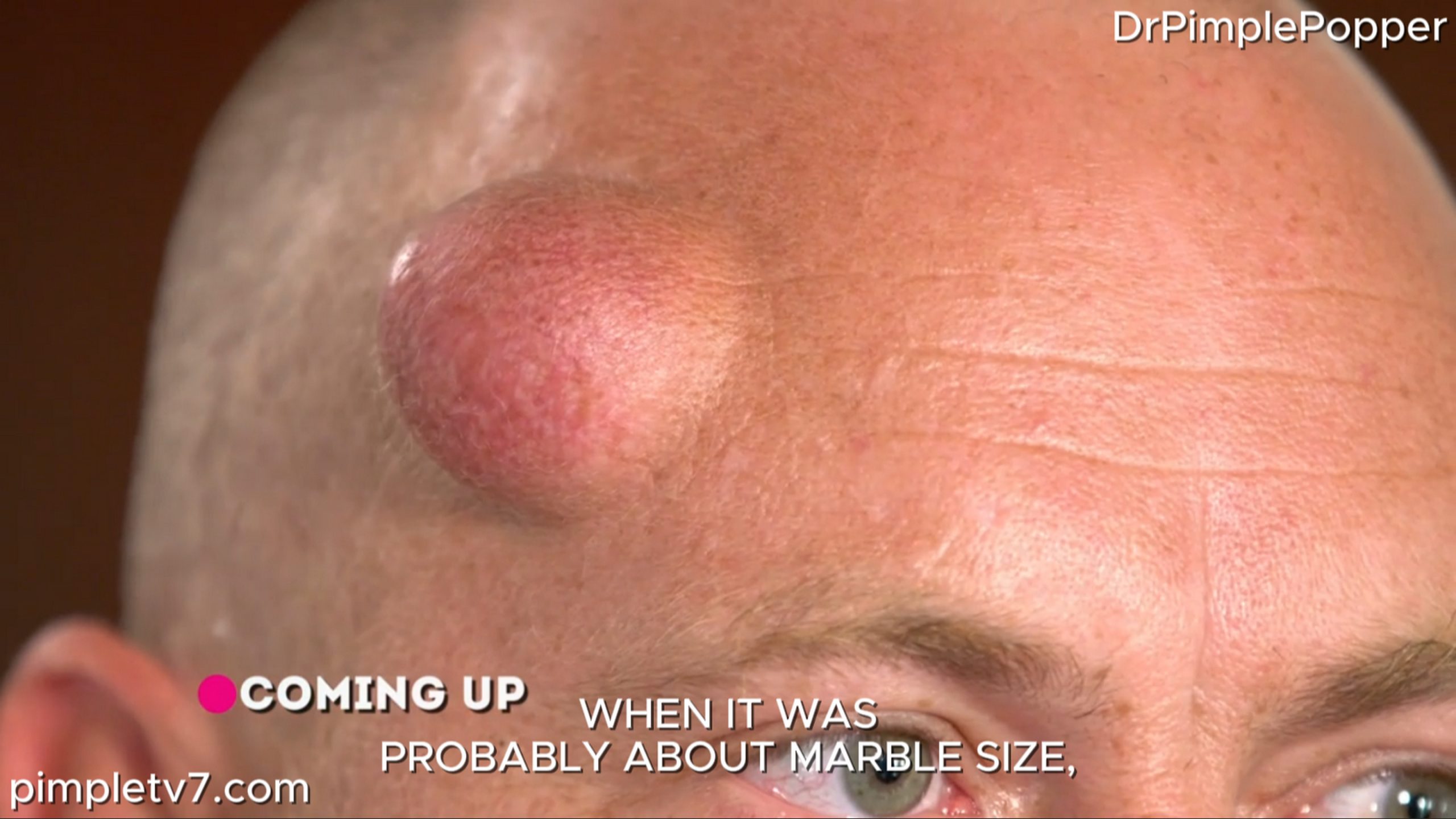 A man has a large knot on his head resulting from a car crash. Dr. Pimple Popper 010726