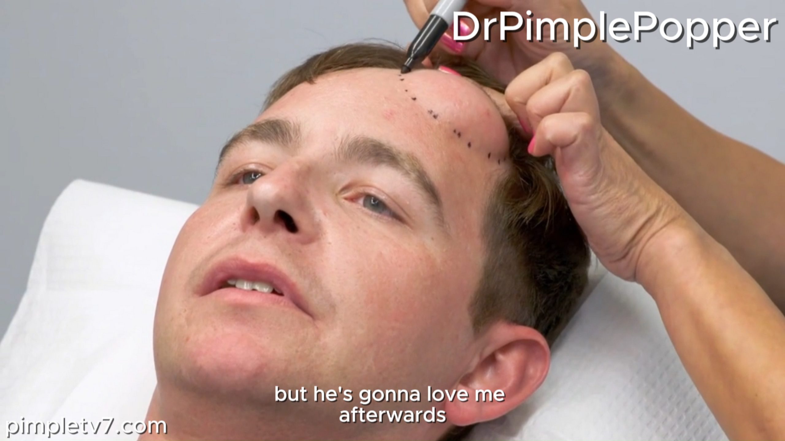 A man who suffers from a giant lump on his forehead. Dr. Pimple Popper 170726