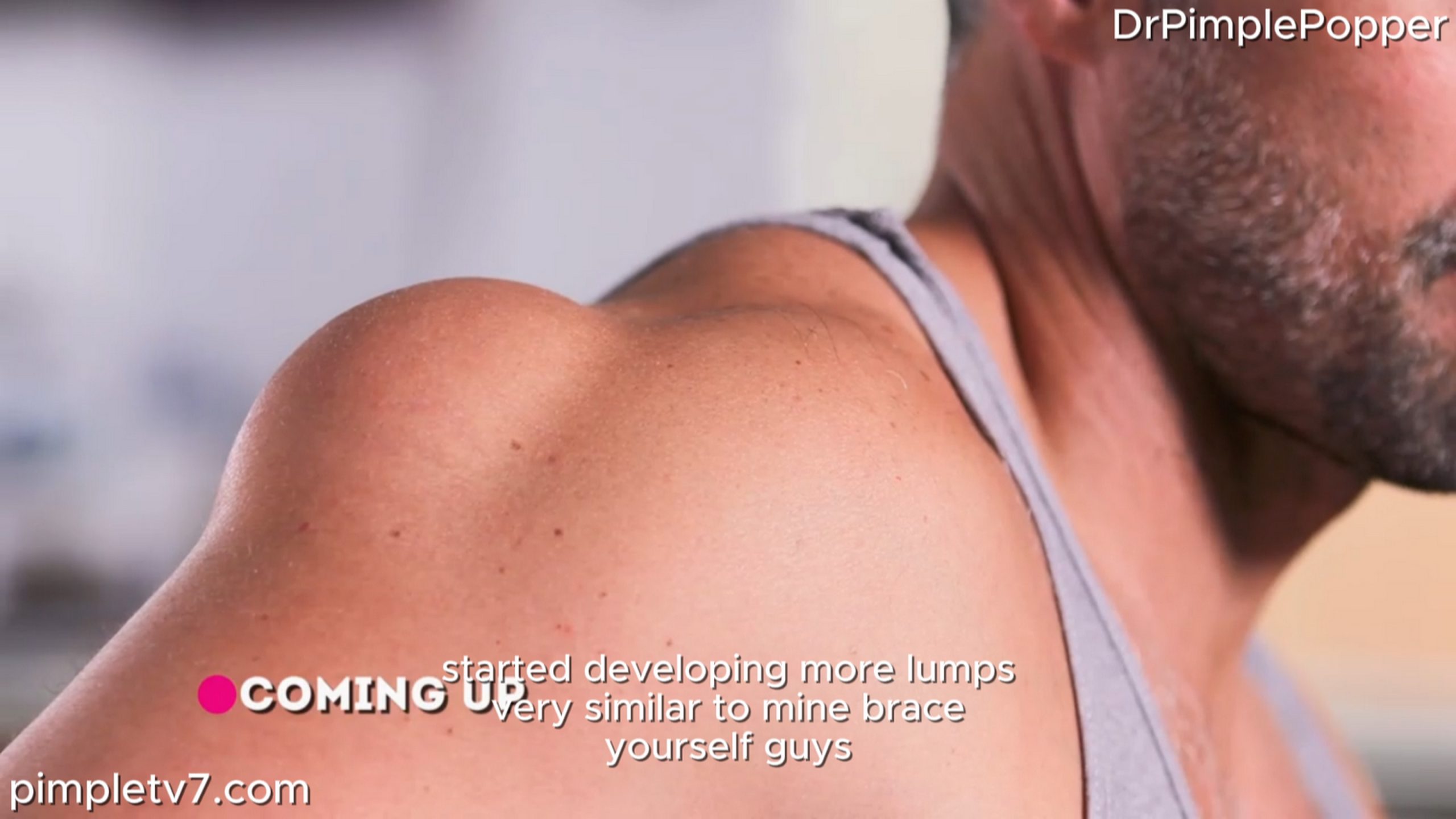 A patient has a bump on his shoulder, and his daughters fear it’s dangerous. Dr. Pimple Popper 020726