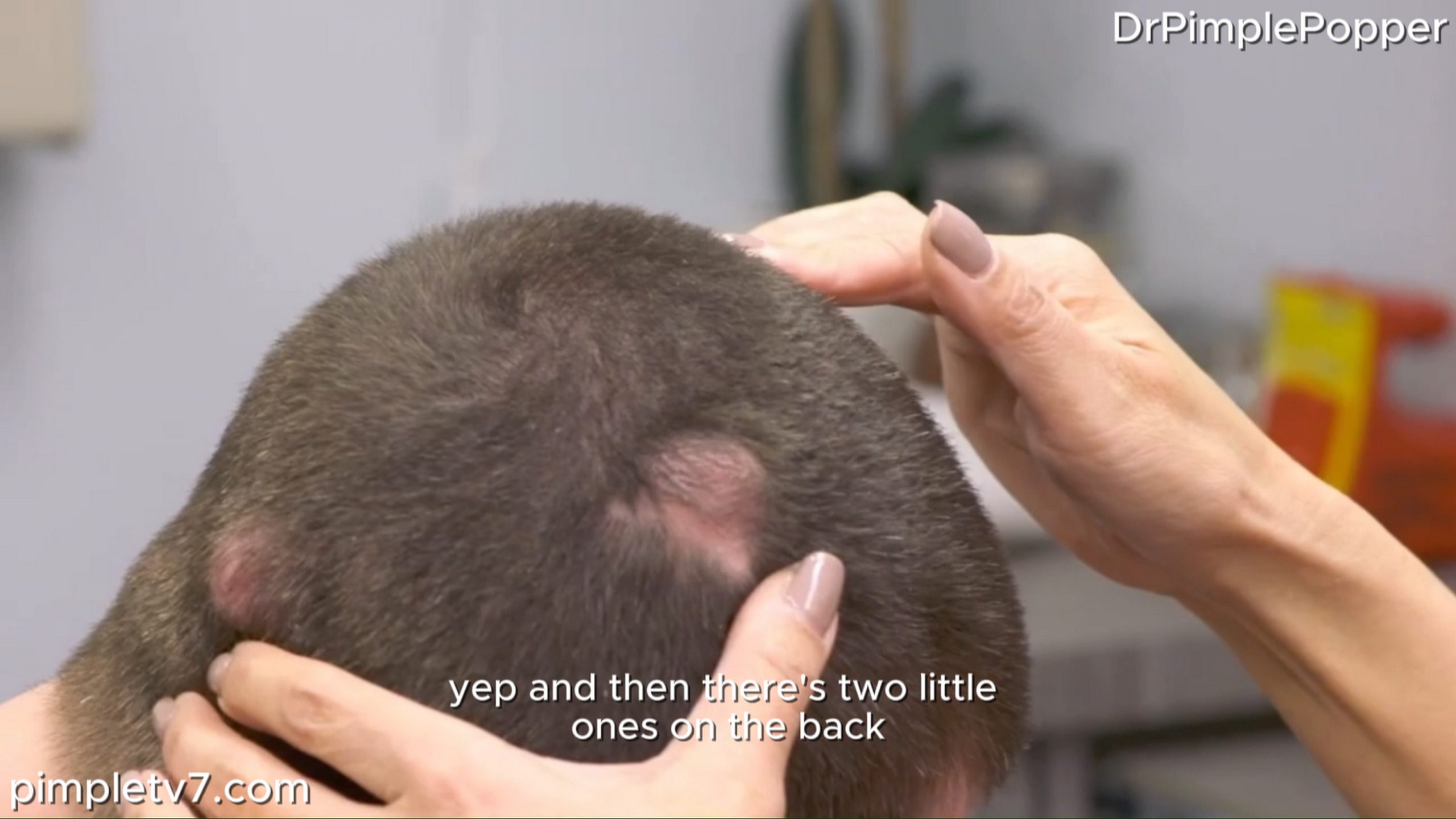 A patient has several lumps on his head that make him fear for his life. Dr. Pimple Popper 030726
