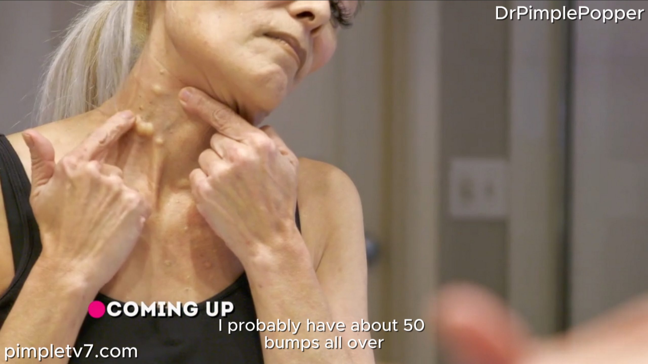 A patient who is distressed because of the bumps all over her neck. Dr. Pimple Popper 050726