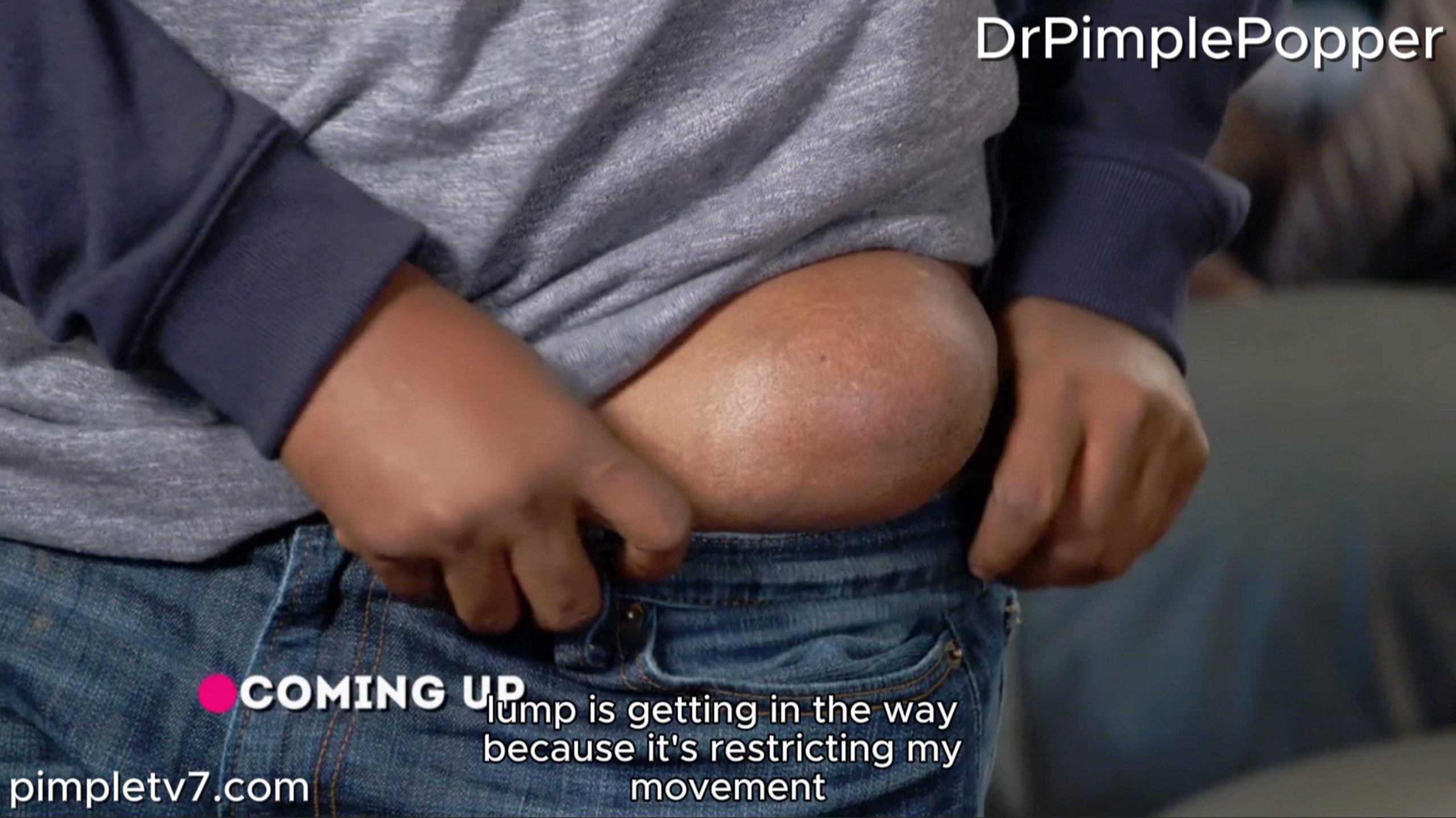 A patient lives with a large lump protruding from his hip. Dr. Pimple Popper 100726