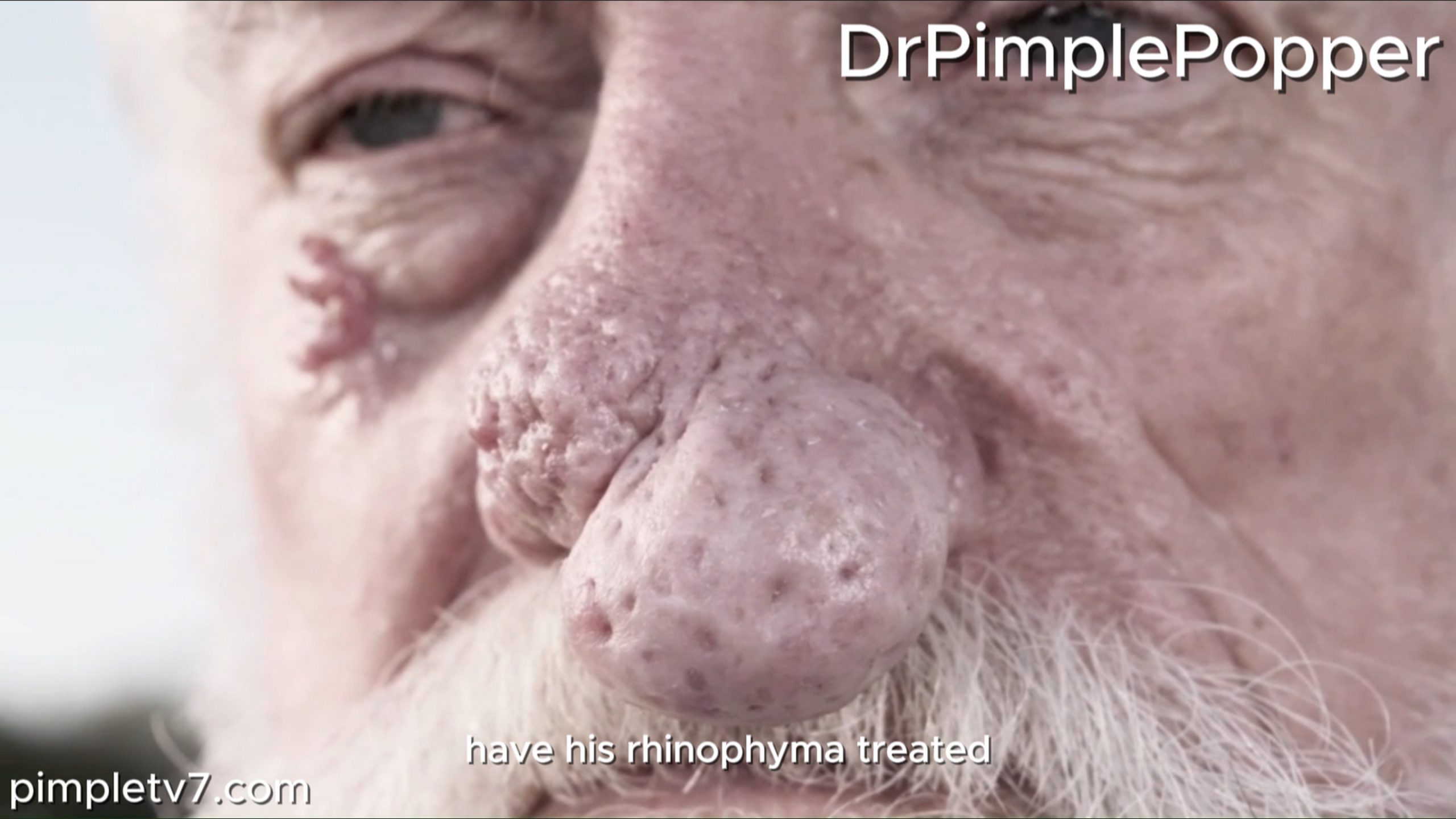 A patient returns to find out if a suspicious growth under his eye is a type of skin cancer. Dr. Pimple Popper 180726