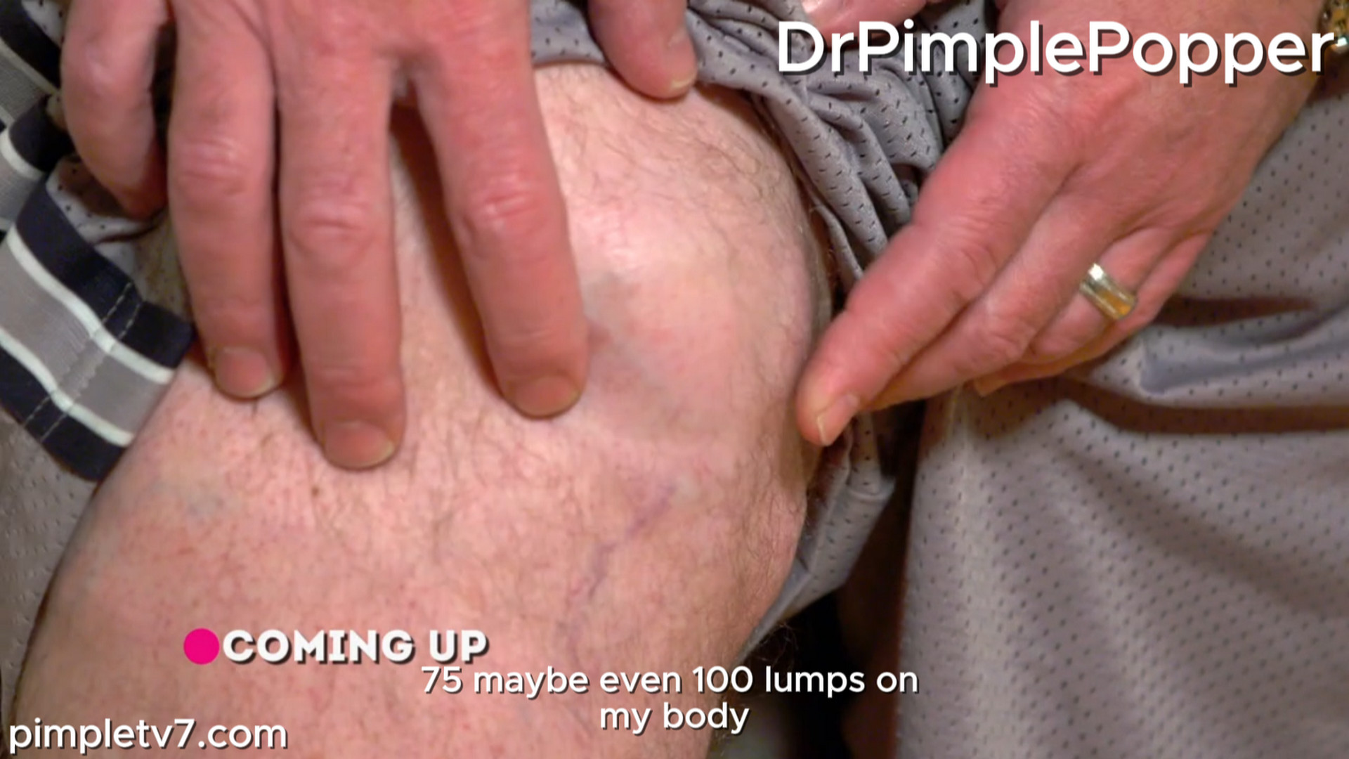 A patient suffers from nearly one hundred lumps varying in size over his entire body. Dr. Pimple Popper 210726