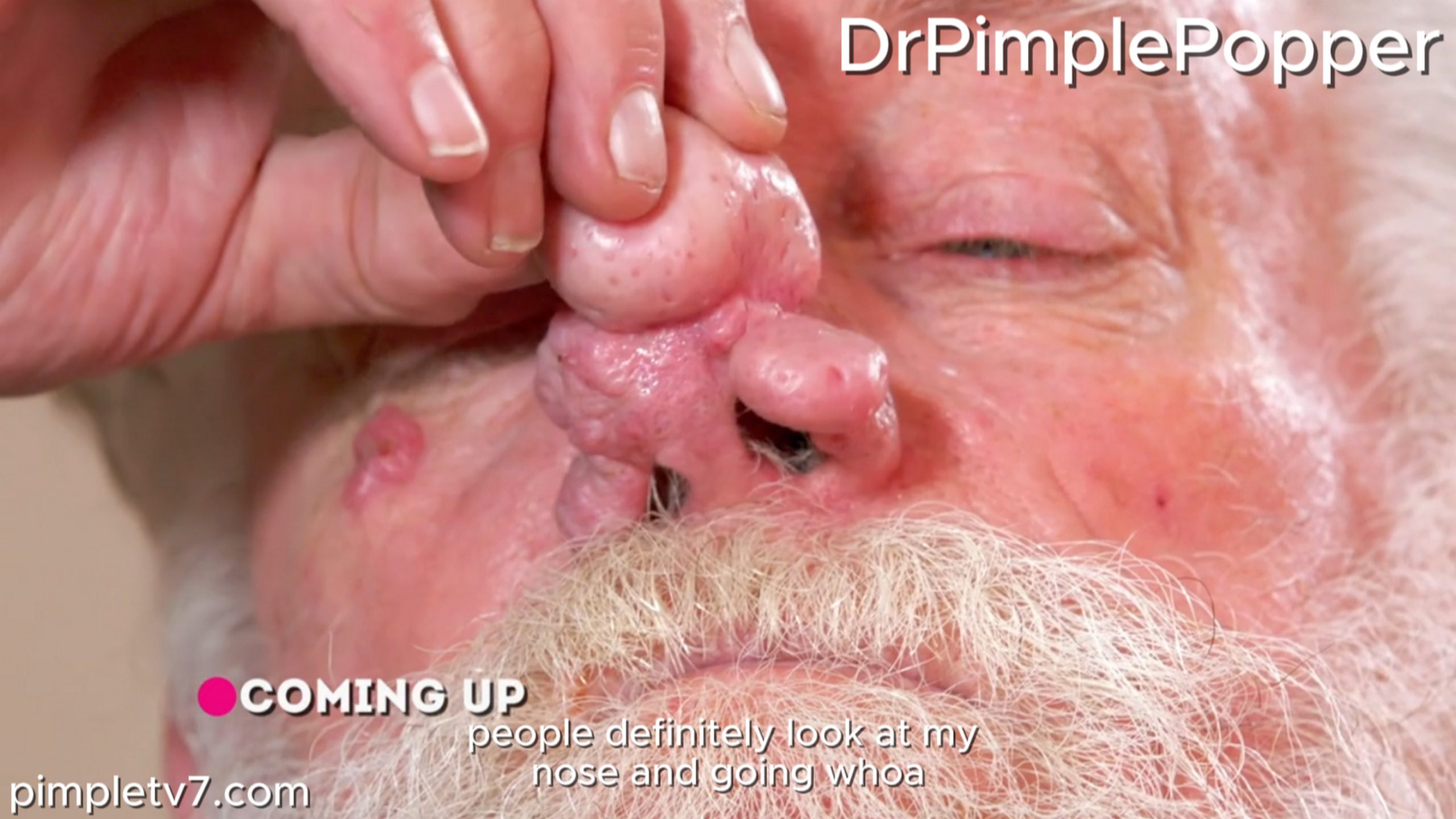 A patient’s nose lump makes it difficult for him to breathe. Dr. Pimple Popper 160726