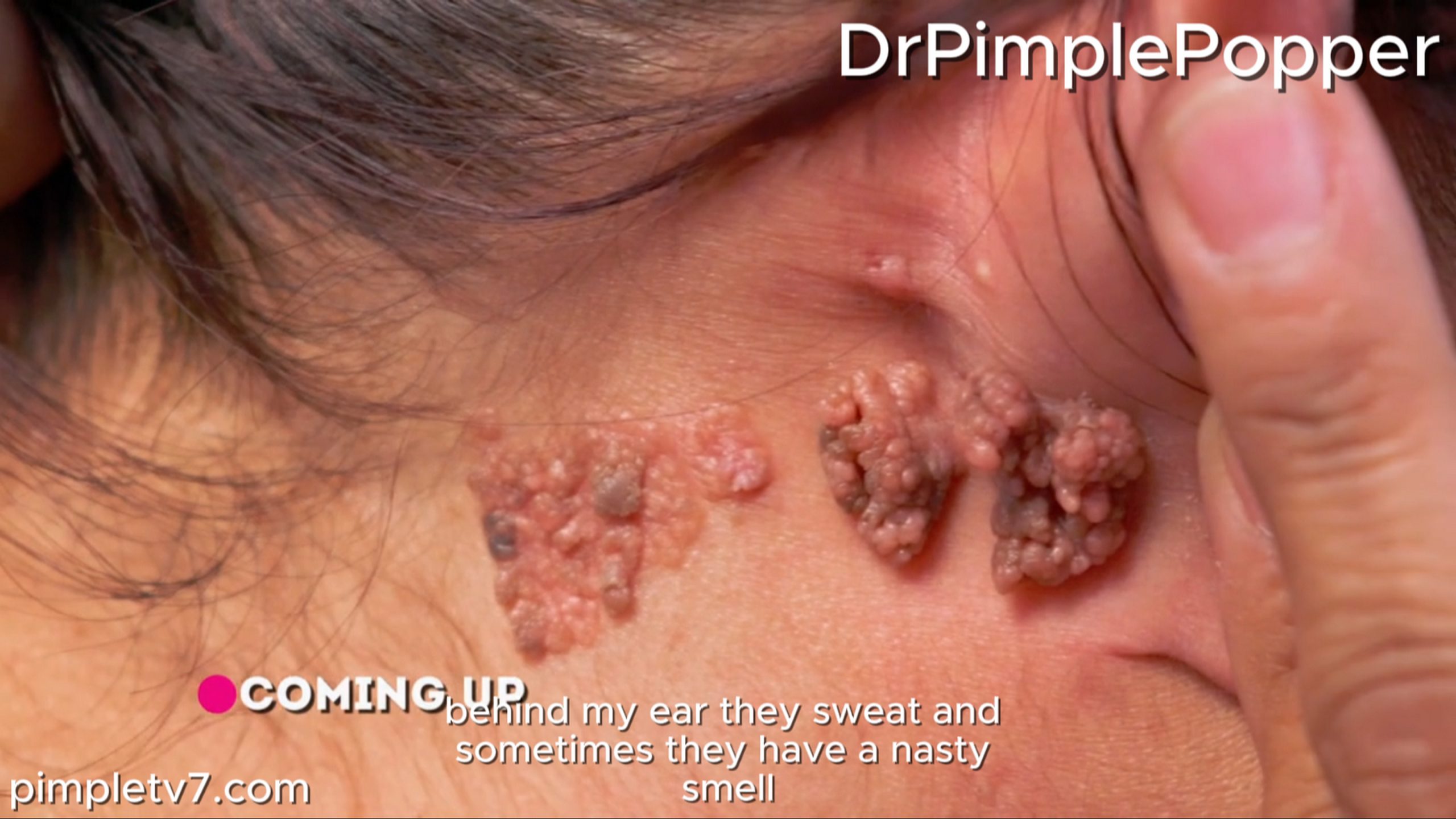 A woman has a lump behind her ear. She has had them all her life. Dr. Pimple Popper 120726