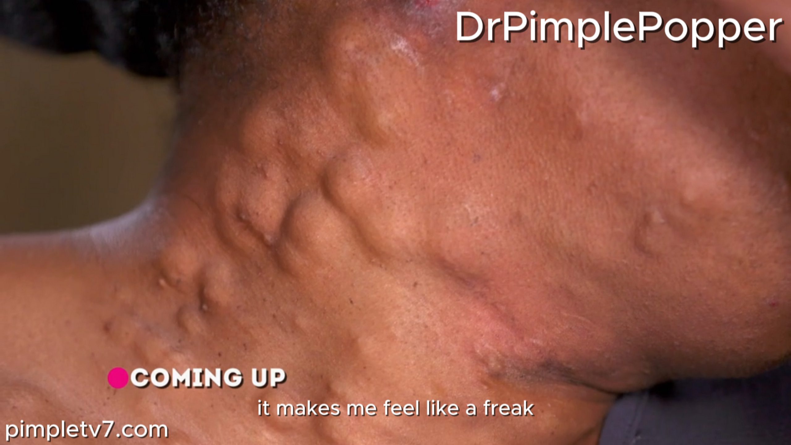 A woman who hopes Dr. Lee can help her with clusters of lumps on her neck and chest. Dr. Pimple Popper 160726