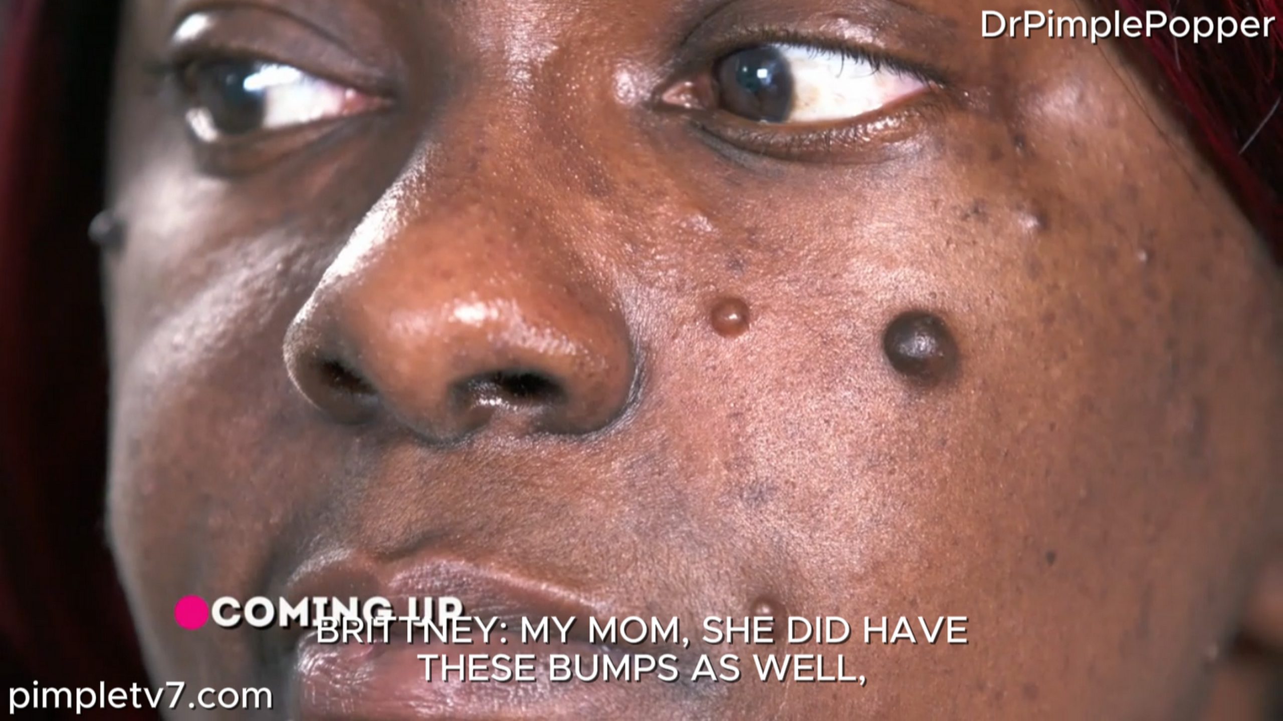 A woman who is covered in mysterious bumps. Dr. Pimple Popper 020726