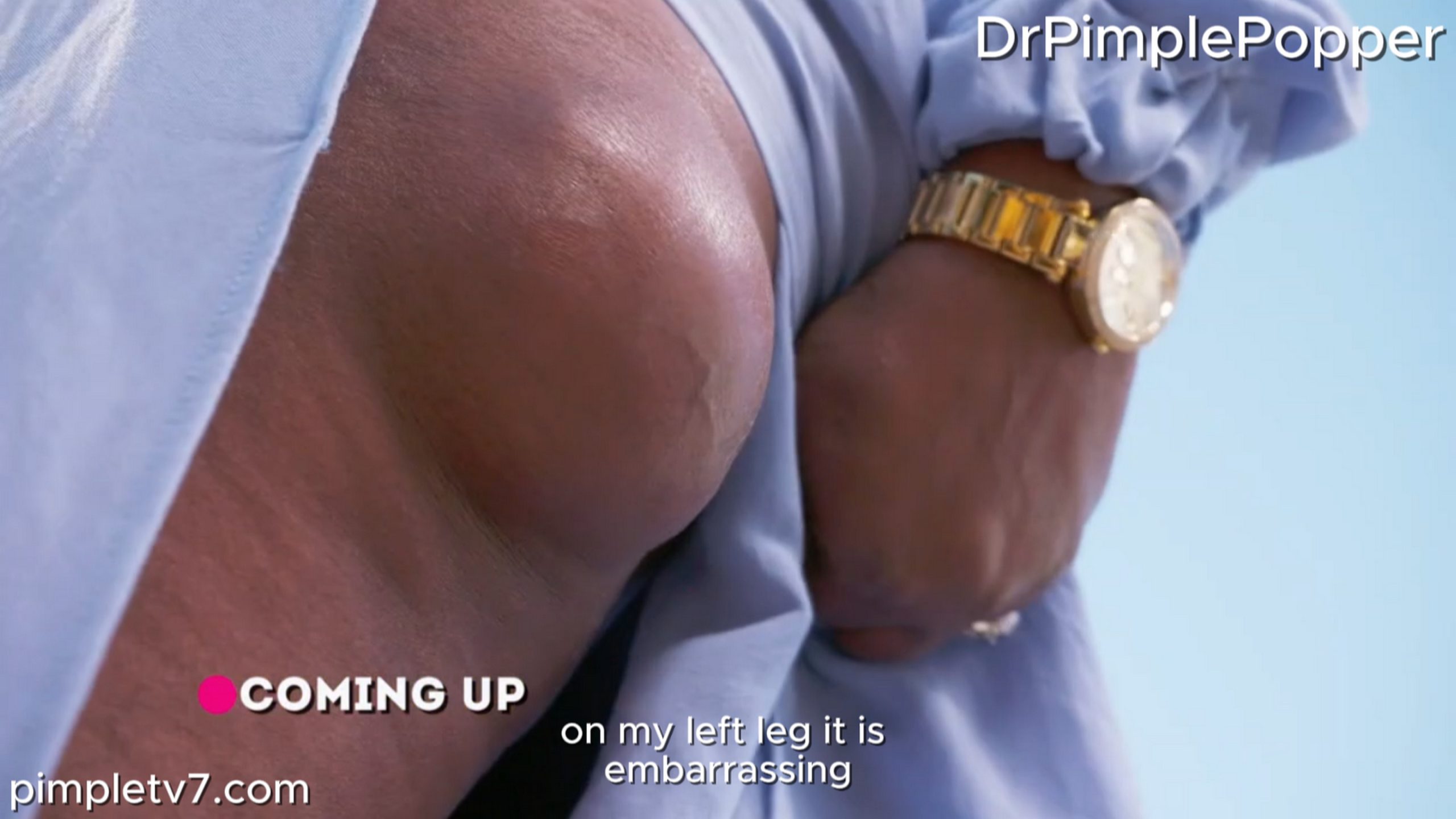 A woman suffers a lump on the back of her thigh. Dr. Pimple Popper 080726
