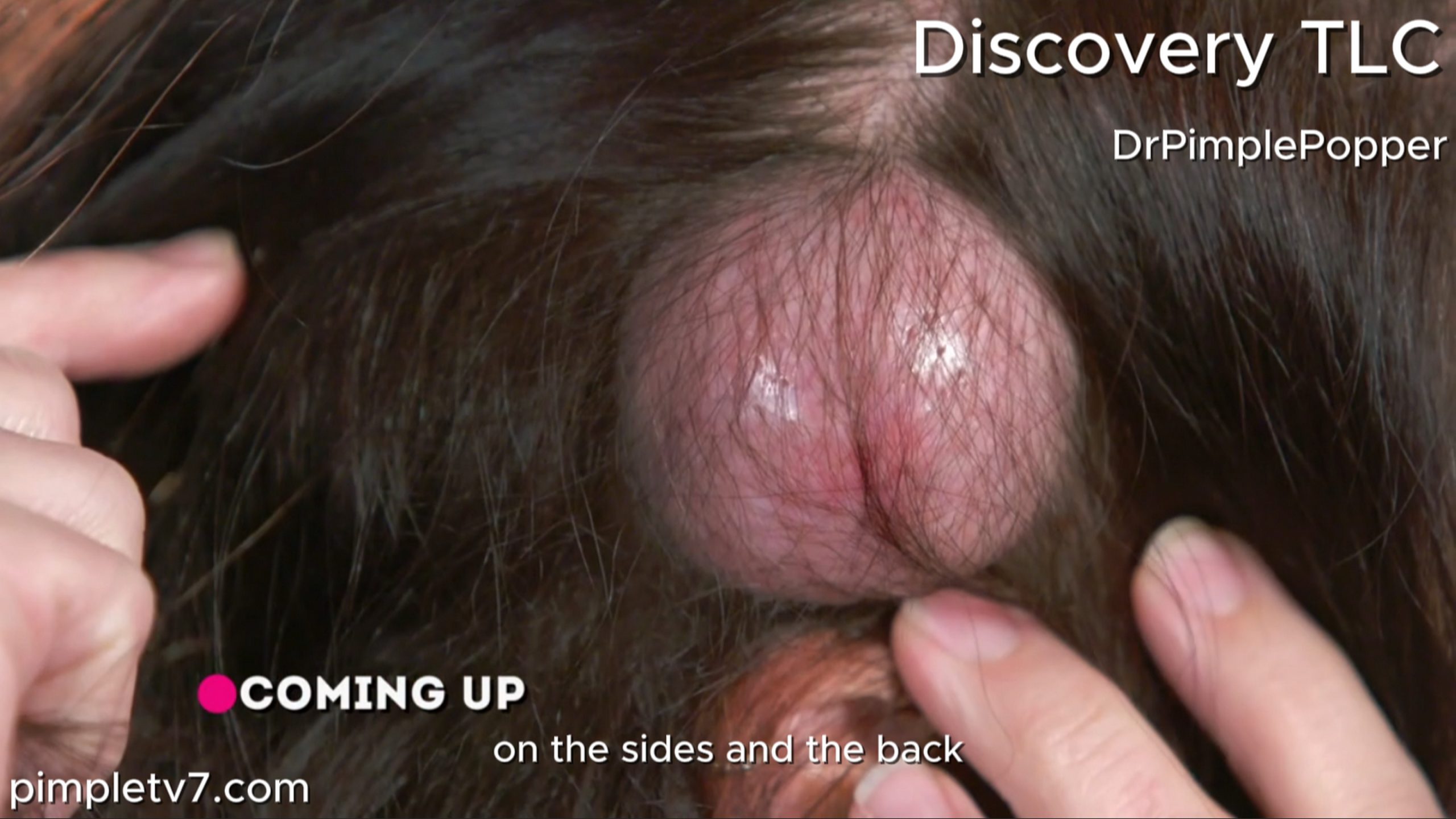 A woman suffers from bumps on her head, including a horned growth that is deeply concerning. Dr. Pimple Popper 090726