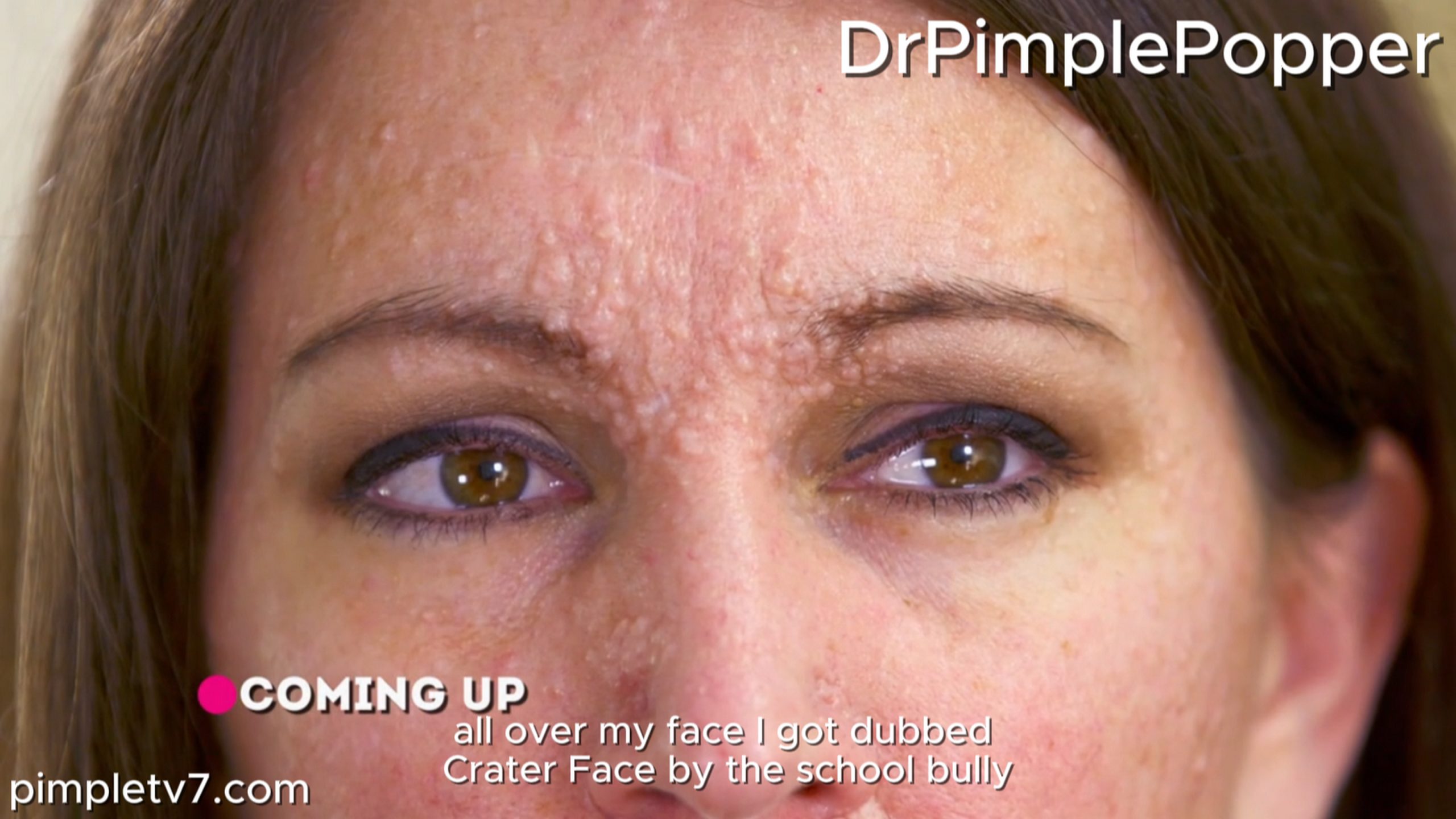 A woman who suffers from clusters of bumps all over her face that make her feel insecure. Dr. Pimple Popper 150726