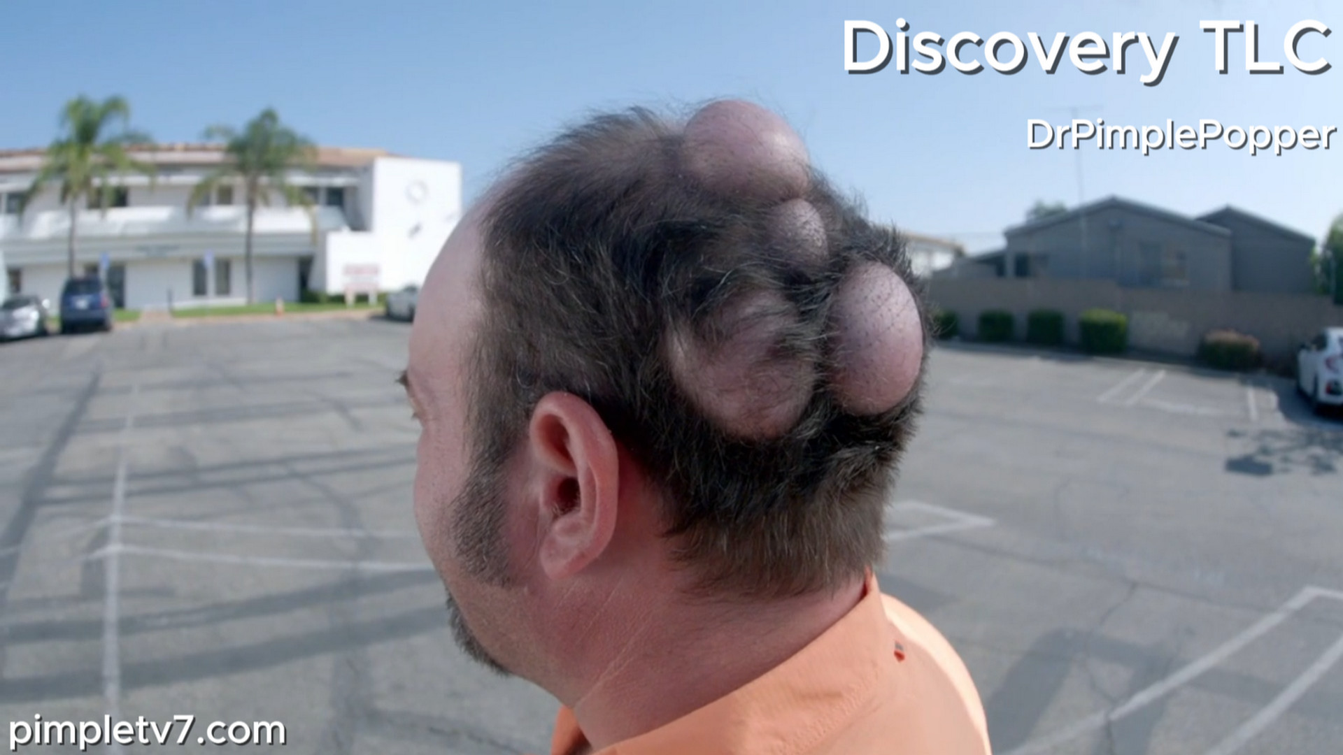 After losing his longtime love, Joe wants the large bumps all over his head removed. Dr. Pimple Popper 210726