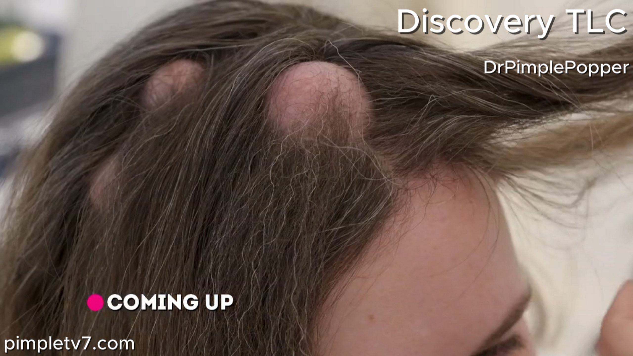 Aimee has a mohawk of cysts on her head. Dr. Pimple Popper 070726