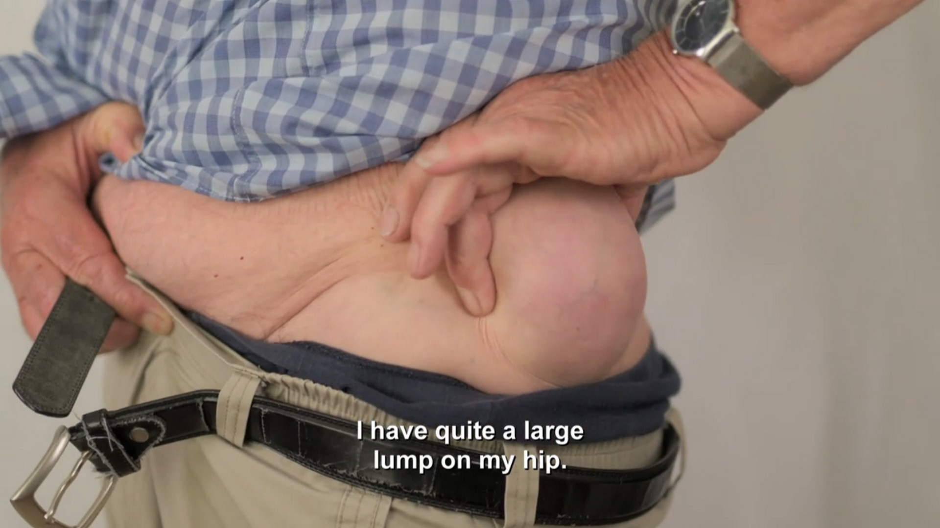 Alan blames a camel bite for his large lipoma. SaveMySkin 260726