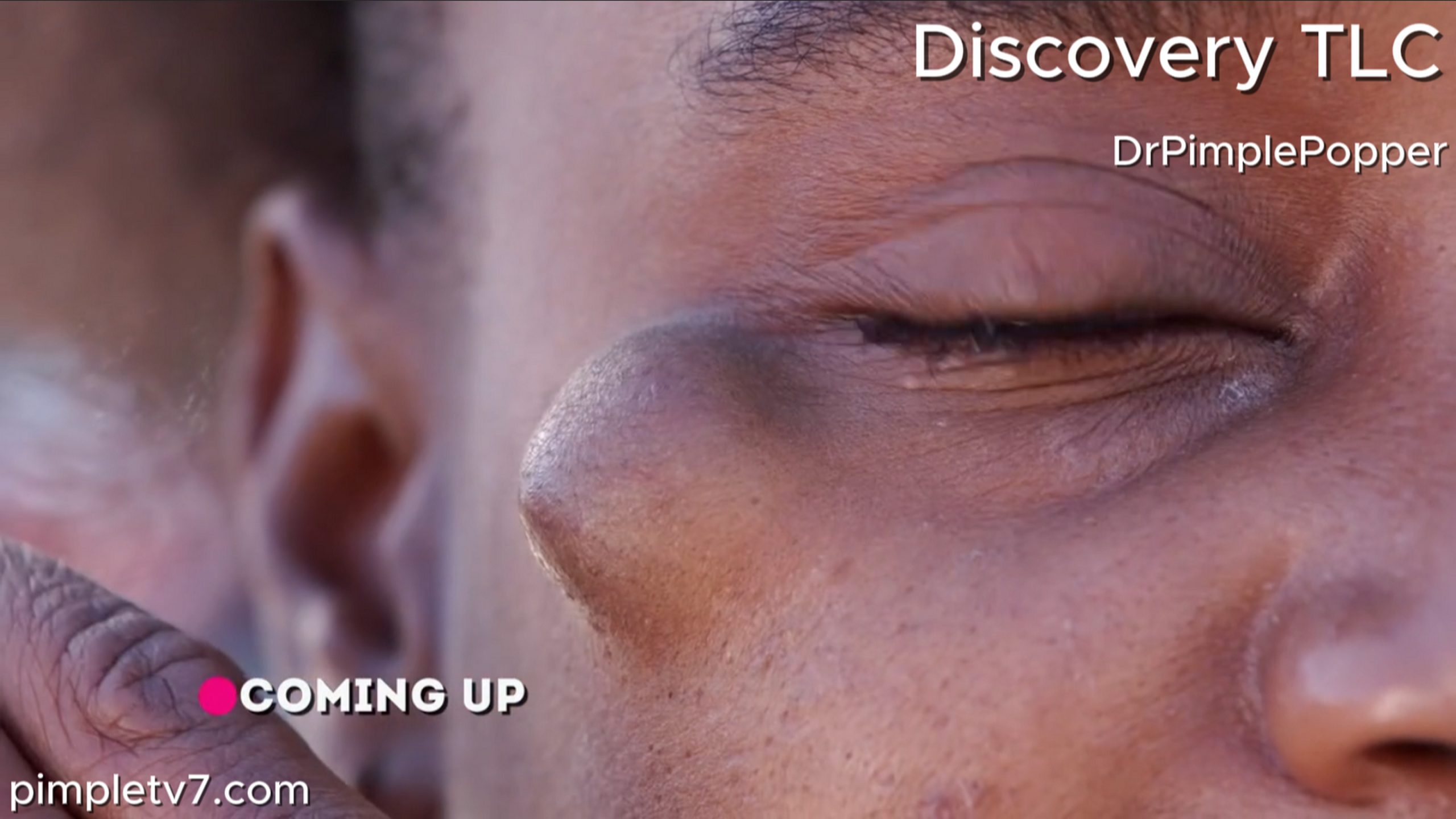 Alexis has a painful cheek cyst that oozes and has a pungent odor. Dr. Pimple Popper 100726