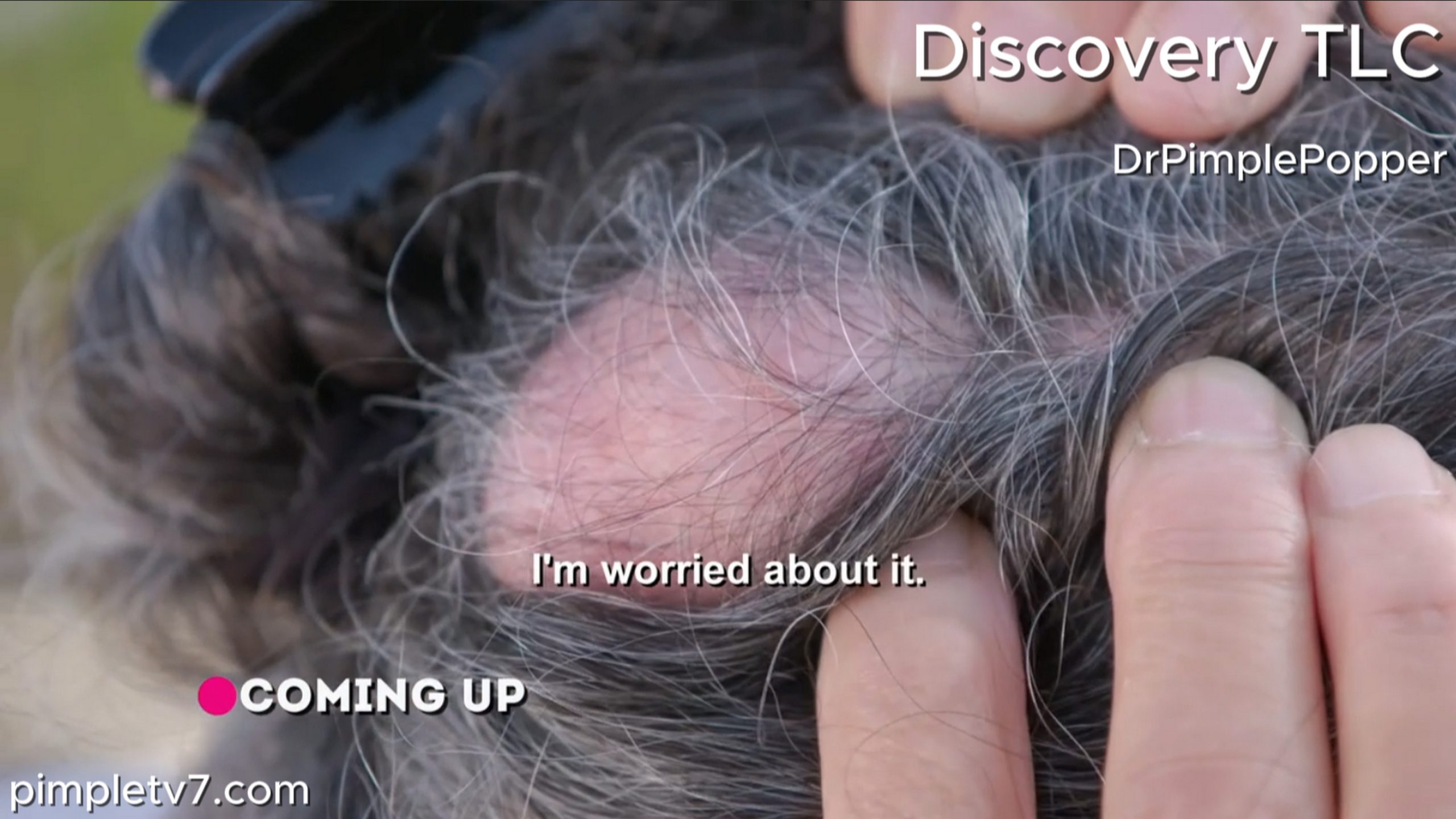 Angela has four growths on her head and hides away from those she loves out of embarrassment. Dr. Pimple Popper 040726