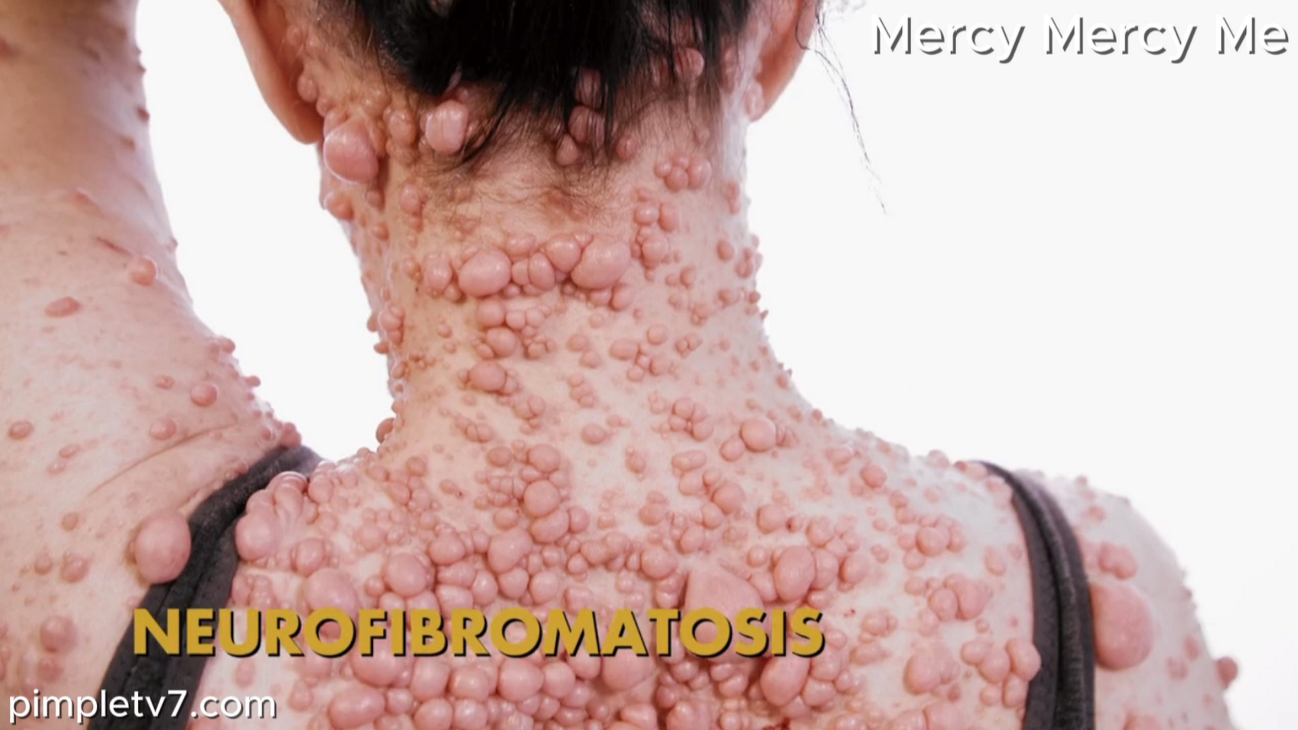 Ashley’s case of neurofibromatosis is one of the worst in the country. Mercy Mercy Me 100726