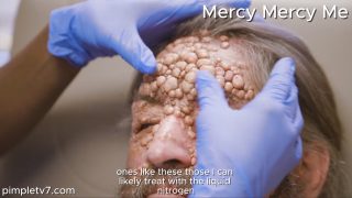 Brad’s face is covered in nodules from a condition that affects less than one in a million people. Mercy Mercy Me 110726