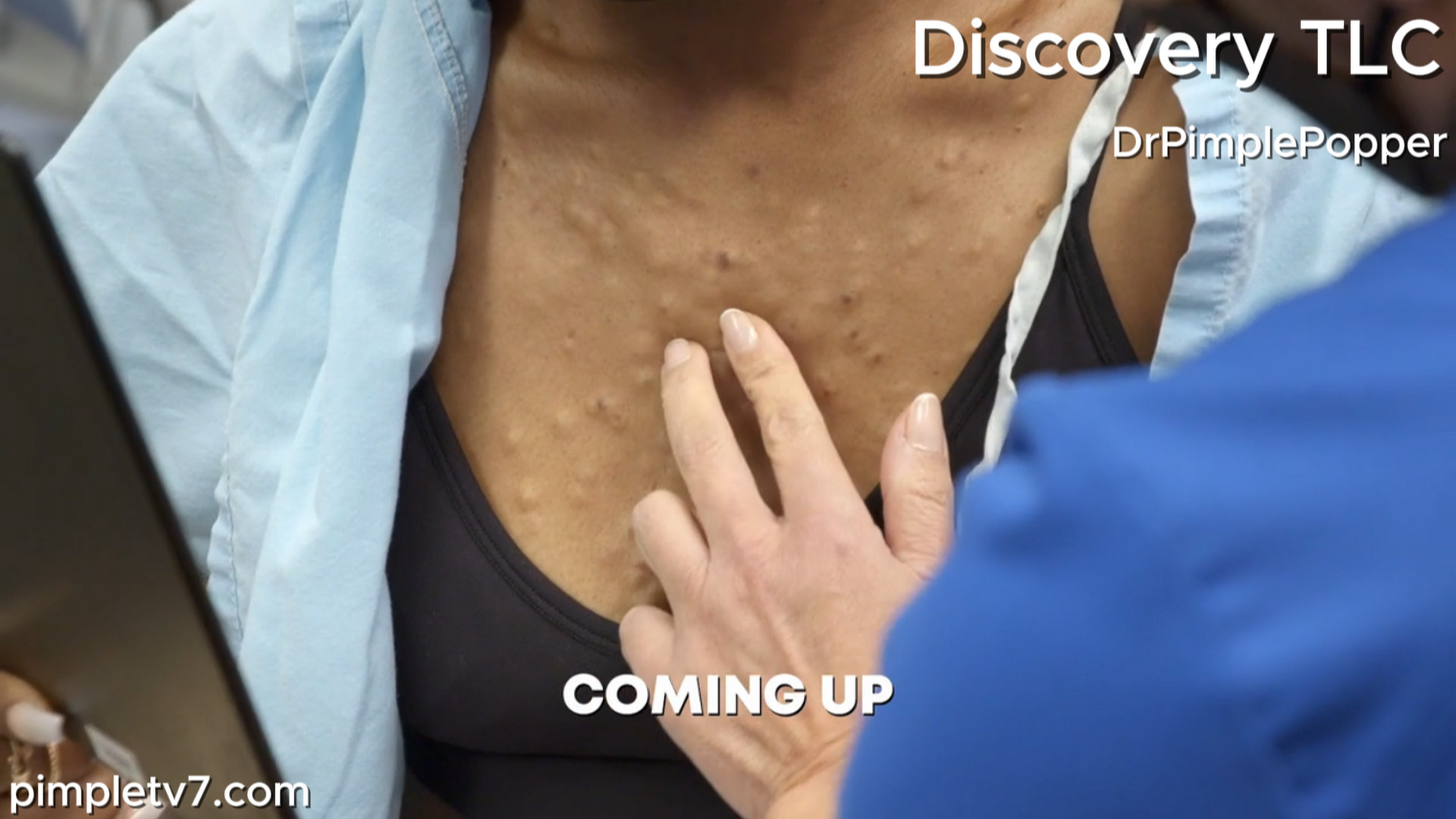 Brittney has hundreds of tiny bumps over her chest that have destroyed her confidence. Dr. Pimple Popper 250726