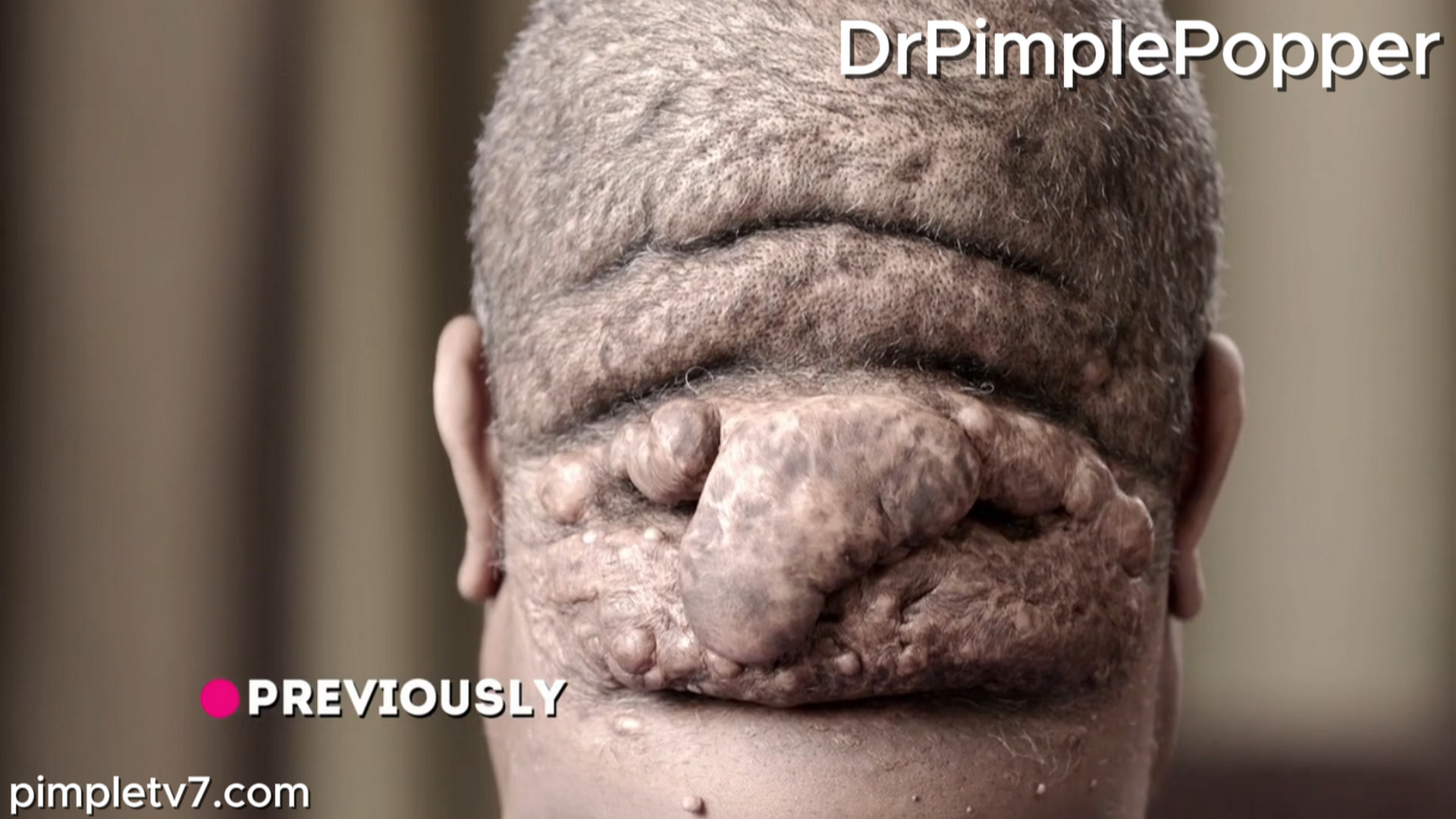 Can Dr. Lee provide the help Reginald needs in order to remove the large rare growths on the back of his head? Dr. Pimple Popper 240726