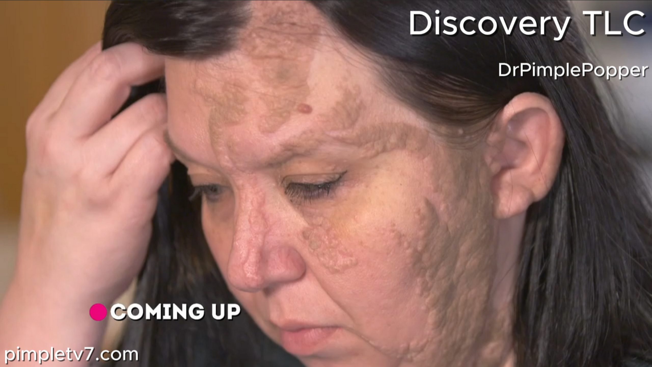 Casey’s birthmark covers most of her face, head, and neck. Dr. Pimple Popper 110726