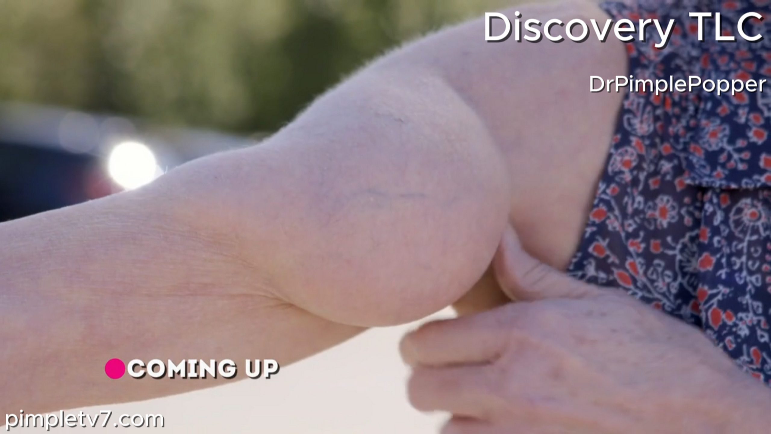 Catherine’s arm lump has grown so big that it’s nearly up to her armpit. Dr. Pimple Popper 180726