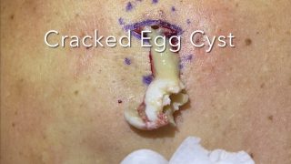 Cracked Egg Cyst. A large deep cyst popped and was removed from the back. Tracks down the deep pocket. MrPopZit 230726