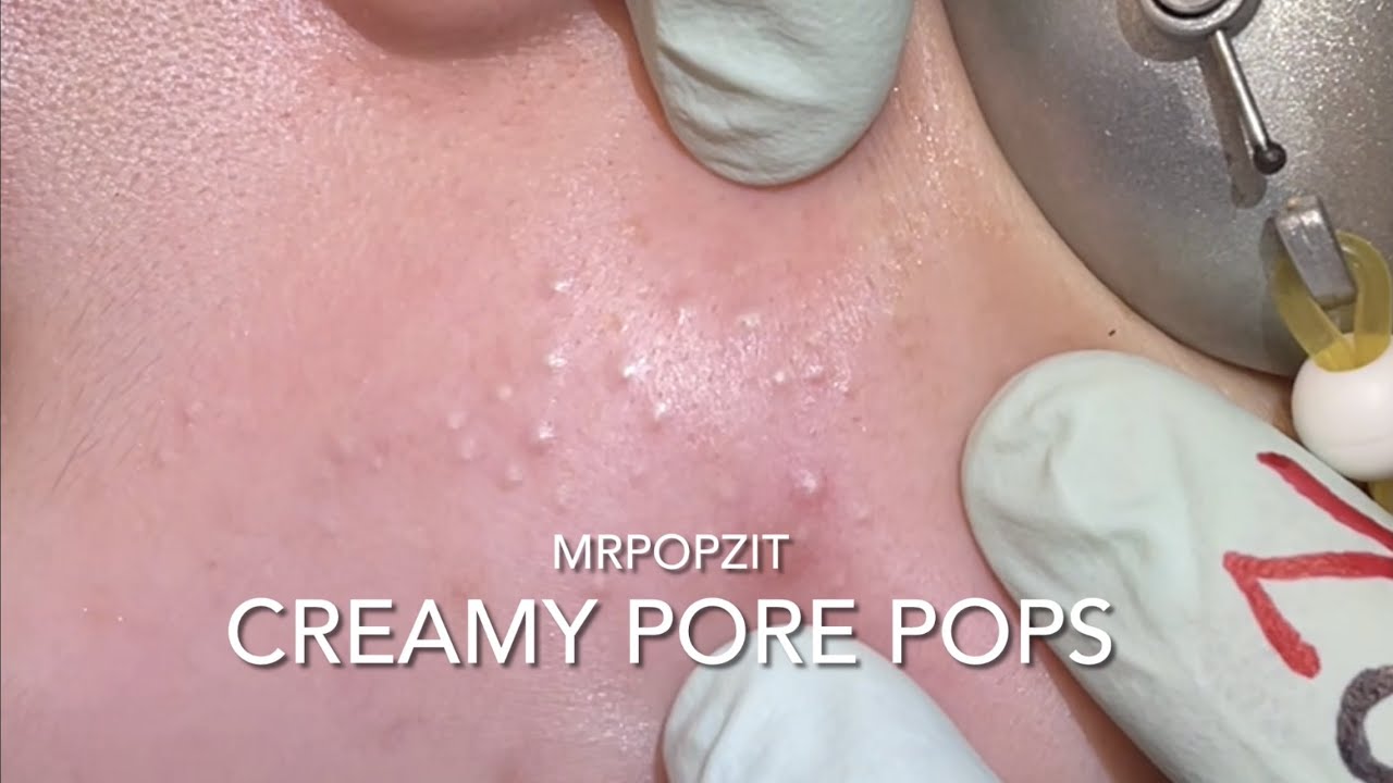 Creamy Pore Pops. Acne extractions. Blackheads and whiteheads. Edited down for just the pops. Pore dir. Mr.PopZit 240726
