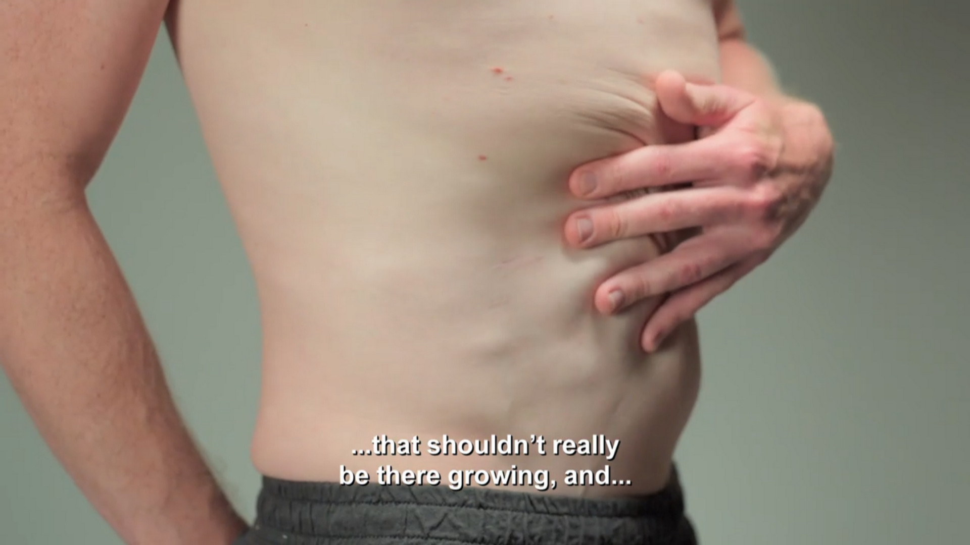 Dan has lumps all over his body. SaveMySkin 270726