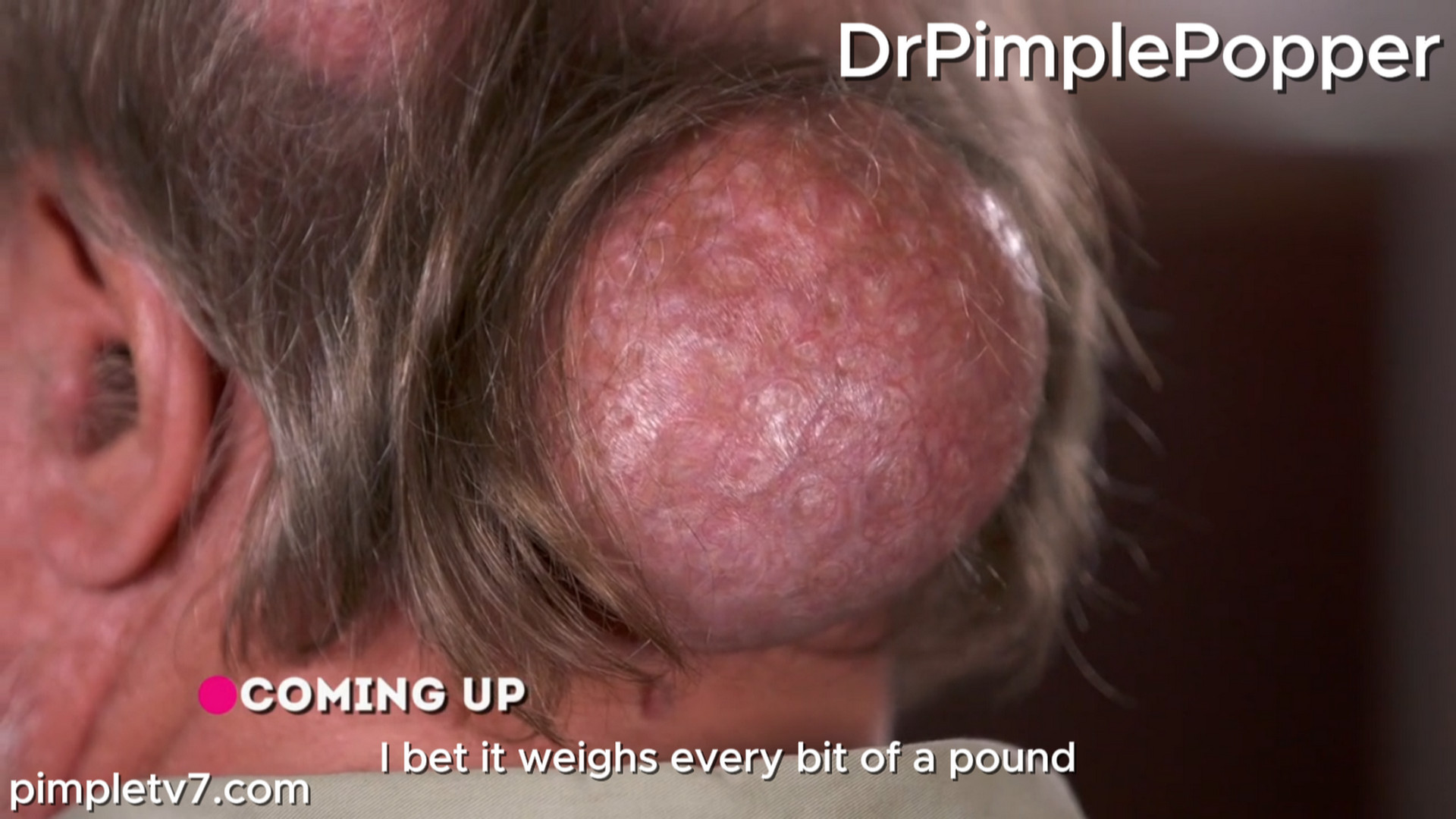 Dennis has several giant growths on the back of his head. Dr. Pimpler Popper 250726