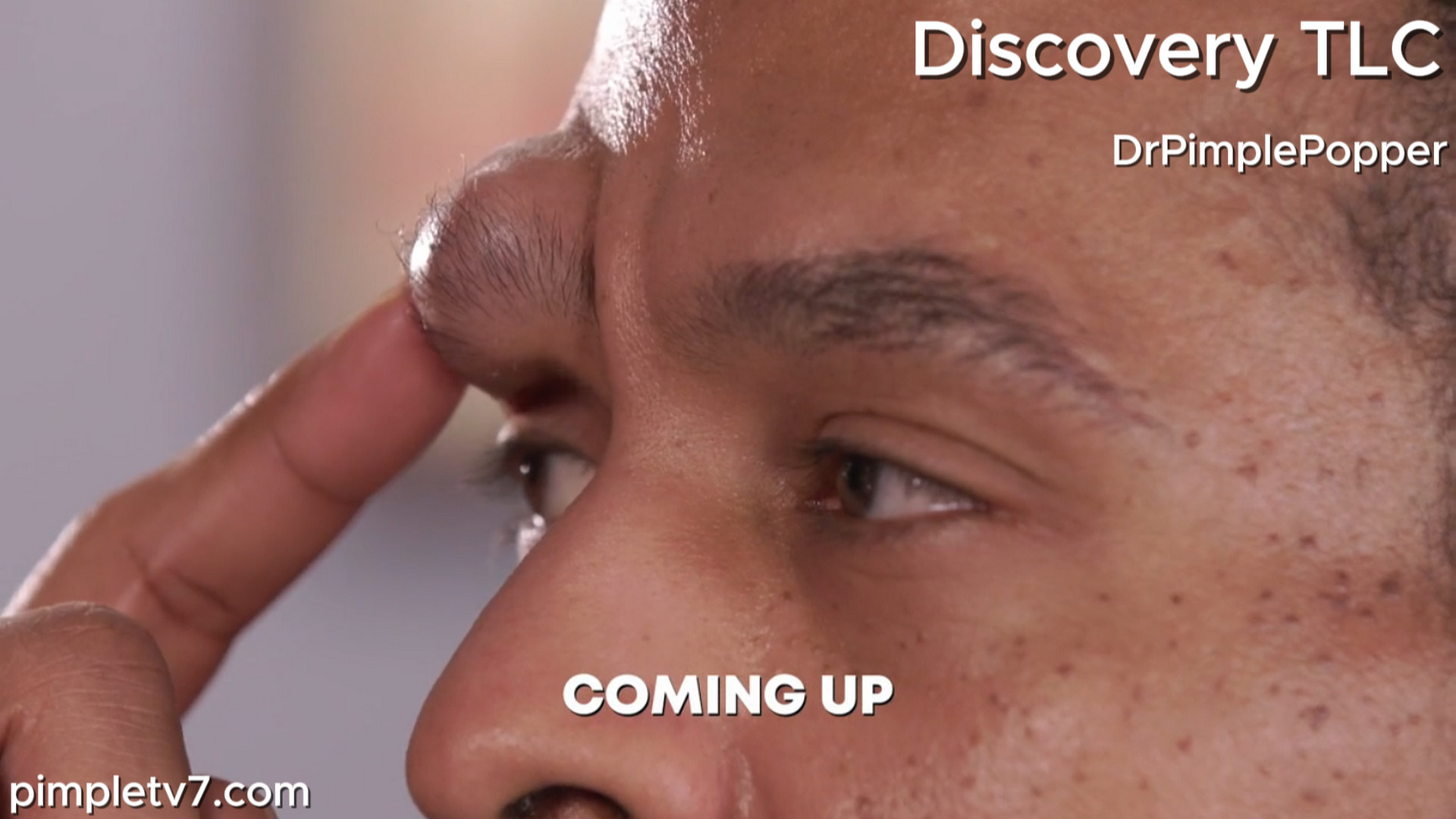 Djuka is a stubborn guy with a stubborn bump. Dr. Pimple Popper 230726