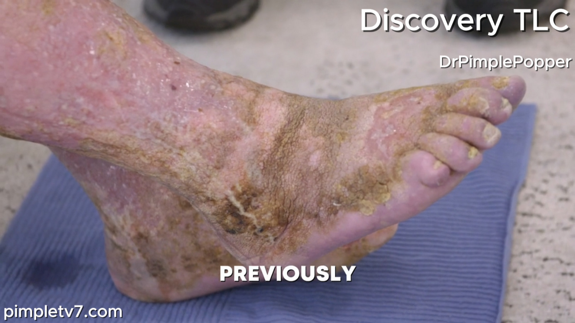 Dr. Lee has a surprise for Paula, whose legs are oozing, odoriferous, and painful. Dr. Pimple Popper 310726