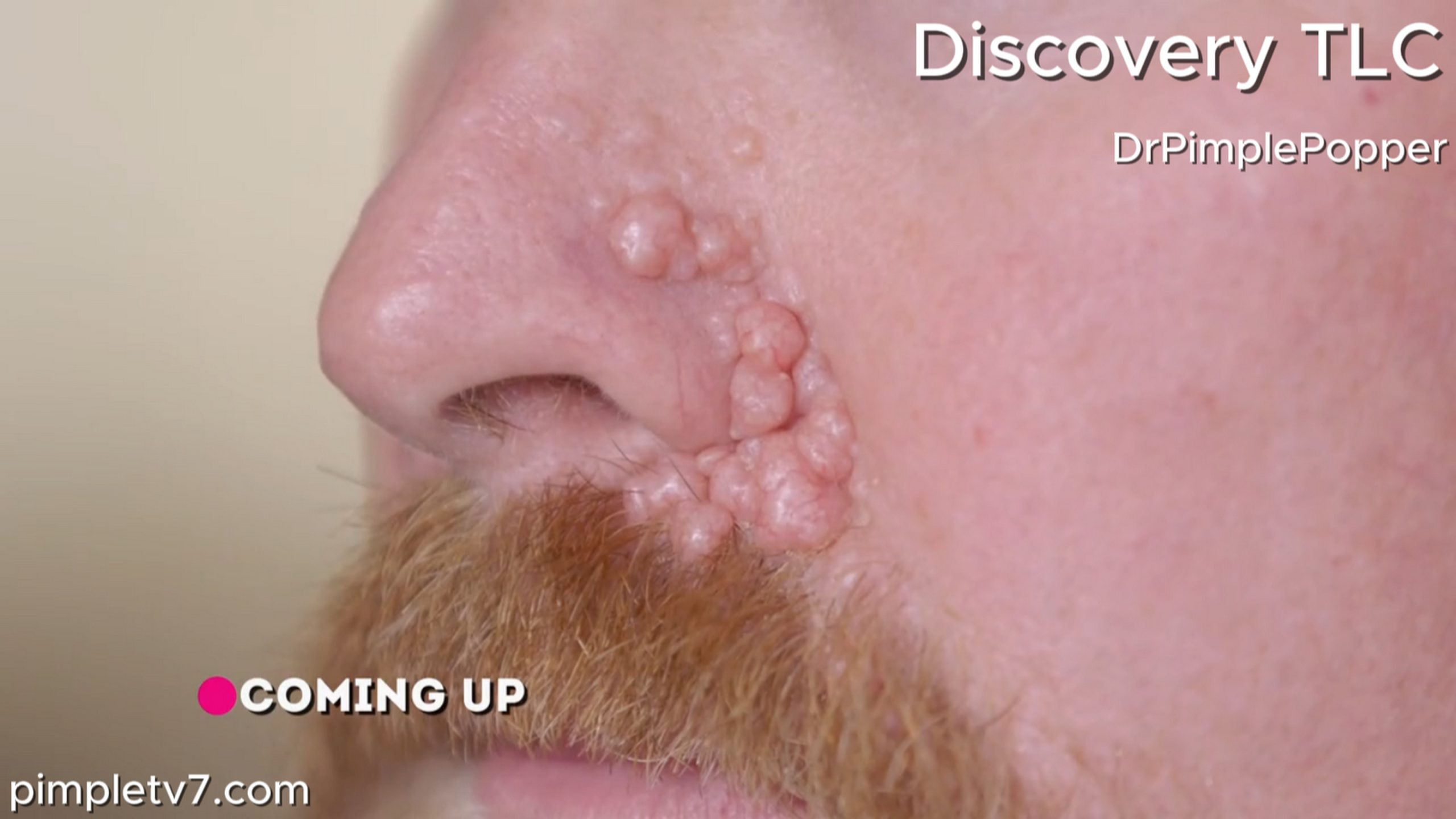 Dwayne wants his nose bumps removed, but he may not be able to make it through the pain of the procedure. Dr. Pimple Popper 140726