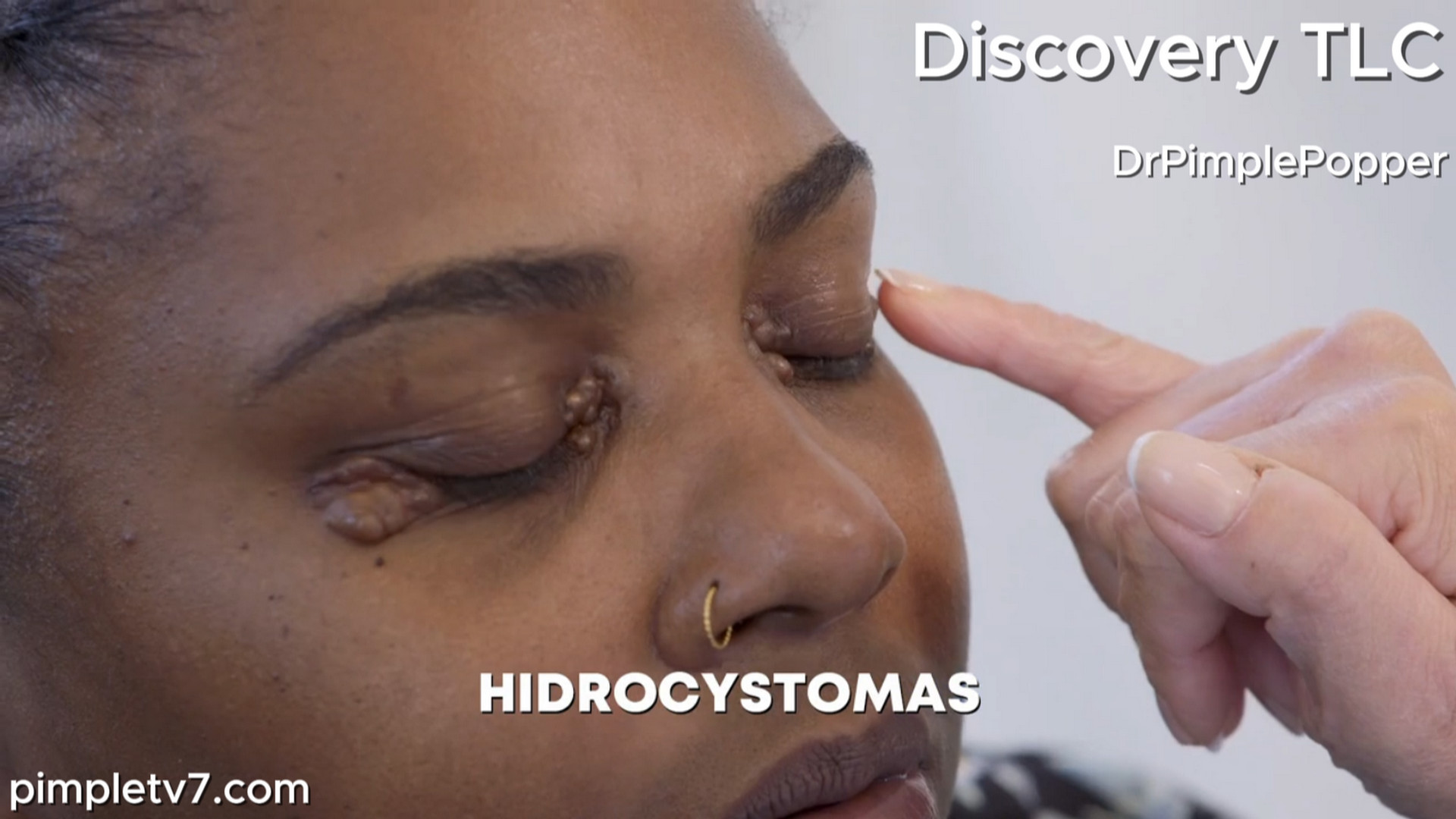 Ebonee covers the tiny bumps around her eyes with sunglasses. Dr. Pimple Popper 280726