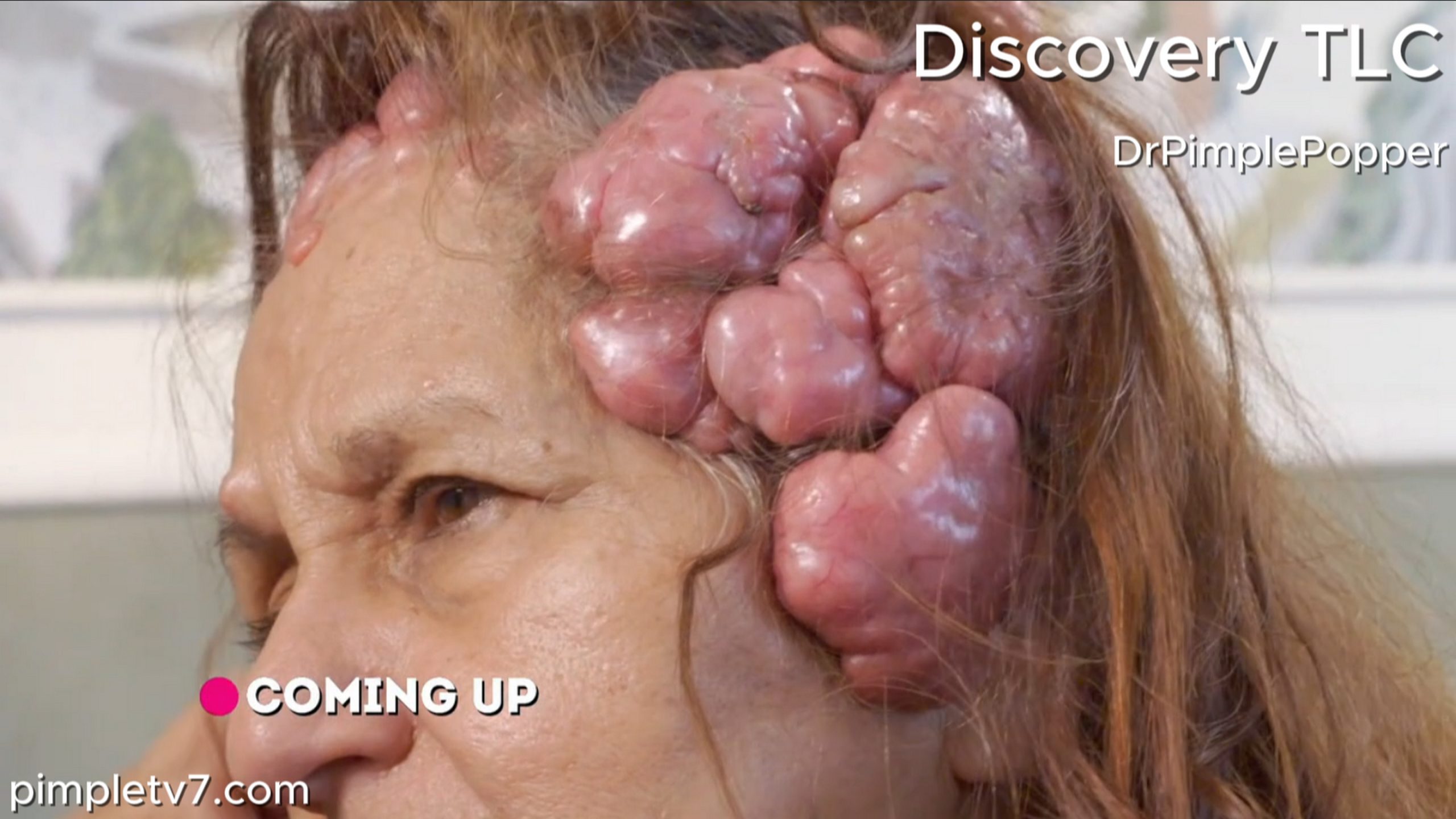 Elizabeth’s head is covered with giant cauliflower-shaped bumps. Dr. Pimple Popper 120726