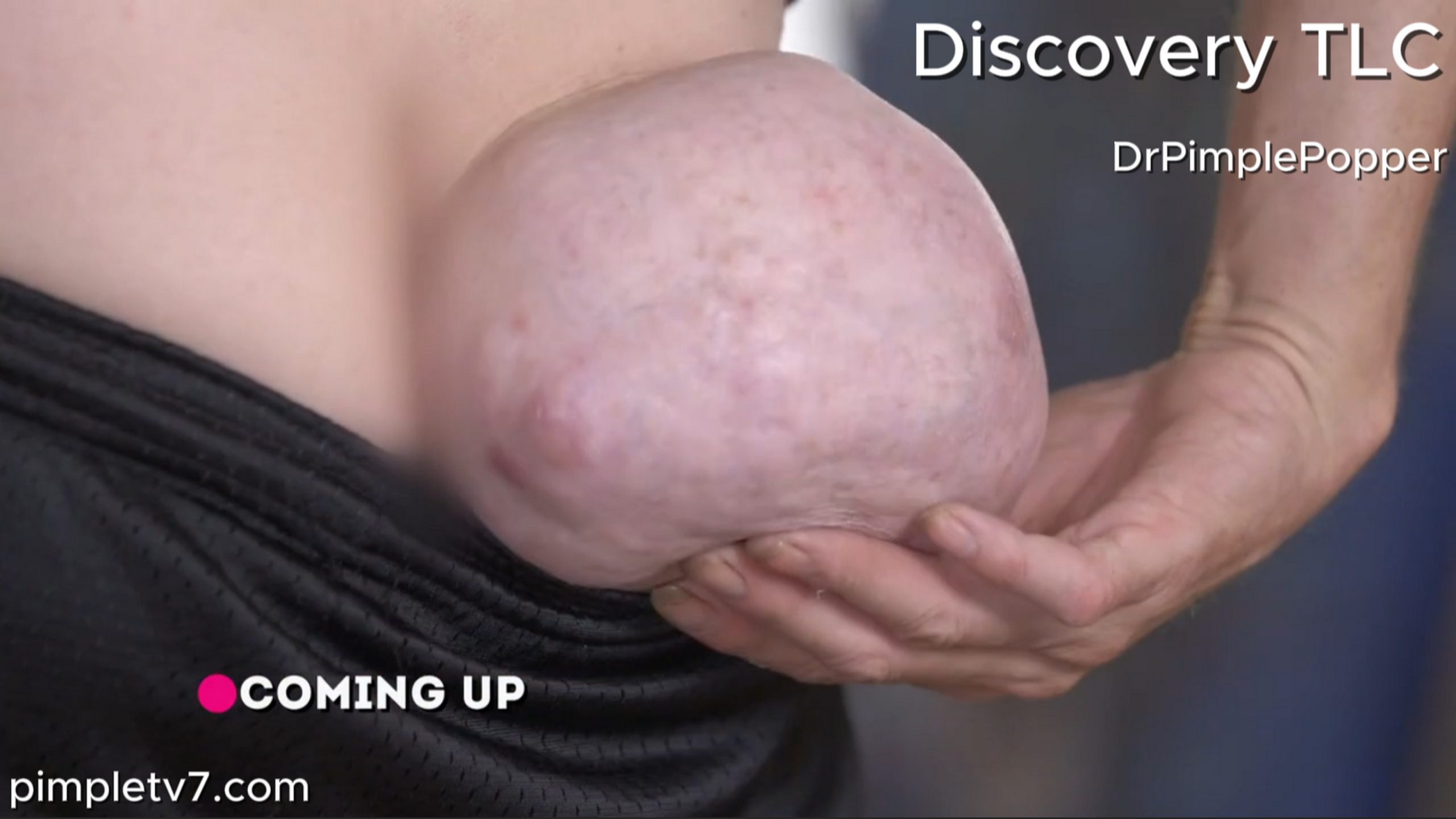 Eric hopes Dr. Lee is able to remove the giant growth from his behind. Dr. Pimple Popper 050726