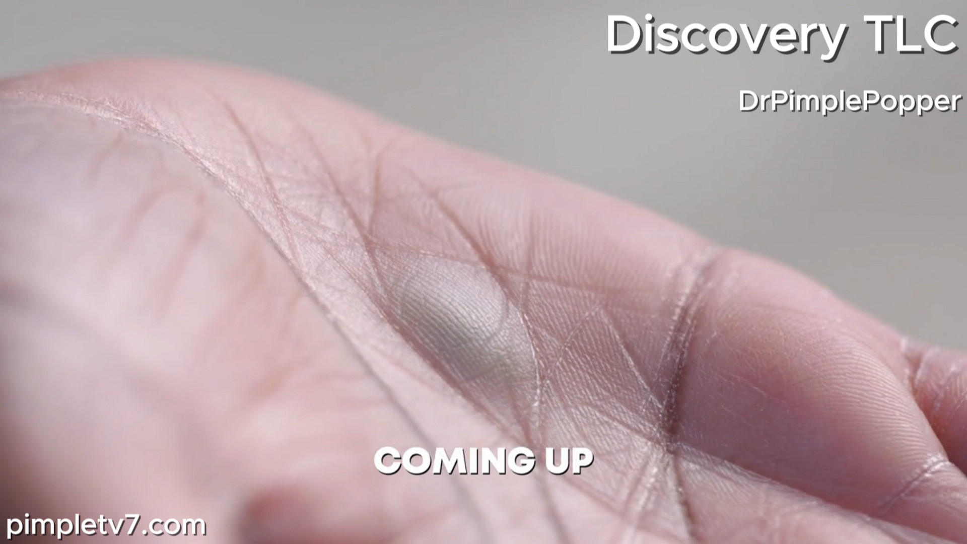 Erica stabbed her hand with a pencil 45 years ago and believes the lead remains trapped in her palm. Dr. Pimple Popper 290726
