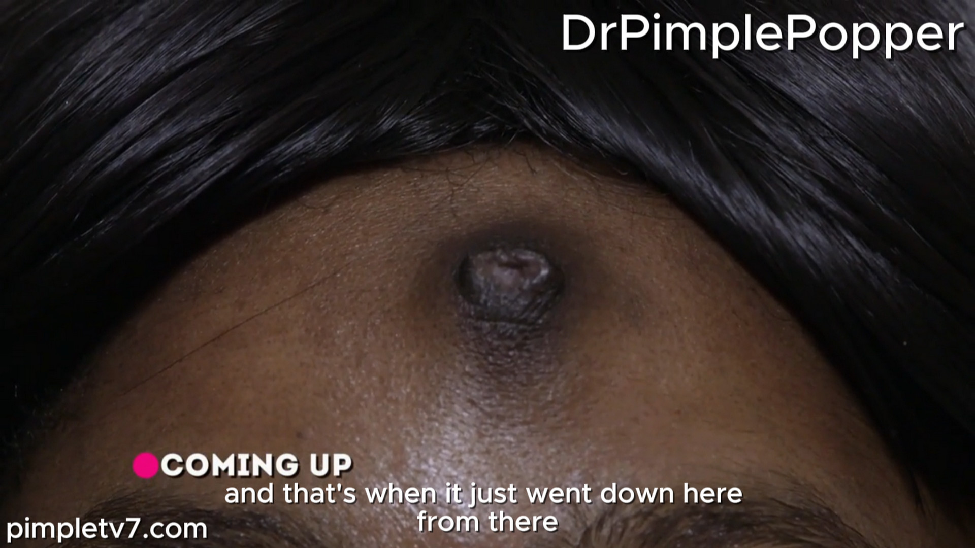 Felicia has a peculiar-looking dark growth on her forehead. Dr. Pimple Popper 270726